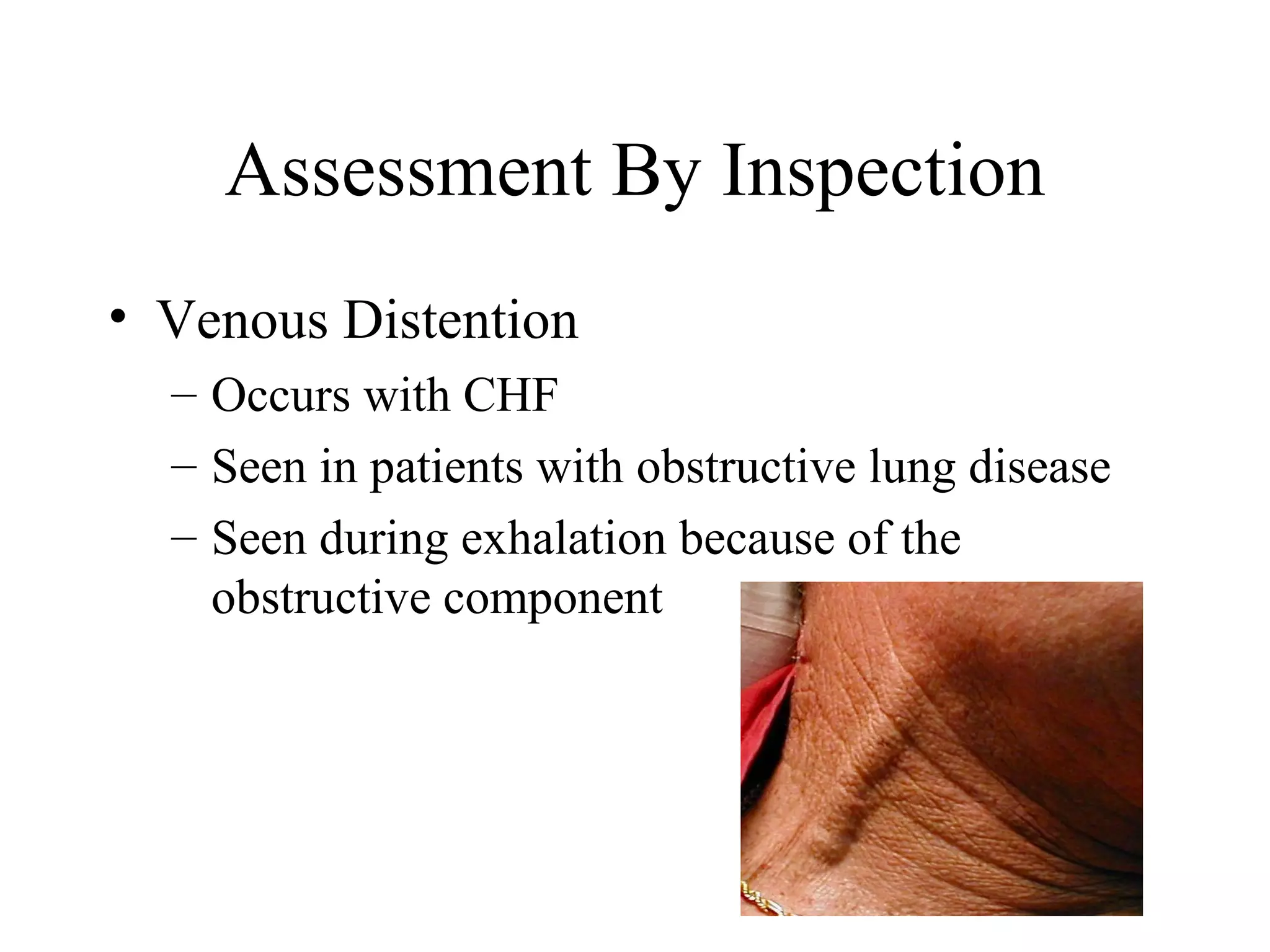 Assessment By Inspection
• Venous Distention
  – Occurs with CHF
  – Seen in patients with obstructive lung disease
  – Seen during exhalation because of the
    obstructive component
 