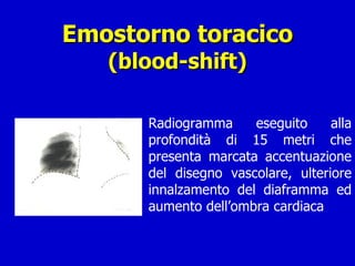 Emostorno toracico (blood-shift) Radiogramma eseguito alla profondità di 15 metri che presenta marcata accentuazione del disegno vascolare, ulteriore innalzamento del diaframma ed aumento dell’ombra cardiaca 