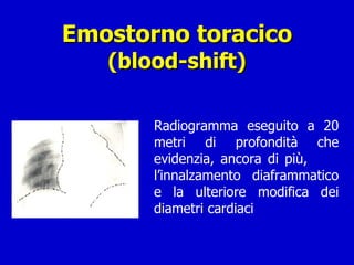 Emostorno toracico (blood-shift) Radiogramma eseguito a 20 metri di profondità che evidenzia, ancora di più,  l’innalzamento diaframmatico e la ulteriore modifica dei diametri cardiaci 