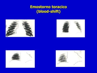 Emostorno toracico (blood-shift) 