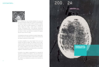 50 51 
LA HISTORIA DE LA RADIOLOGÍA 
1972–2012: CUARENTA AÑOS DE TC 
Esto se reemplazó por sacos de frijoles alrededor de la cabeza del 
paciente para mantener el objetivo fijo y mantener un haz homogéneo. 
Los primeros escáneres de cabeza de EMI se instalaron en muchos 
países, lo que marcó una mejora importante en la capacidad de 
obtener imágenes del cerebro y mejoró mucho la atención de 
pacientes. Posteriormente, EMI y otros fabricantes desarrollaron 
tomógrafos con aperturas del gantry lo suficientemente grandes para 
que entrara el cuerpo, que permitieron la obtención de imágenes 
tanto del cuerpo como de la cabeza. 
La tomografía de cuerpo que se presentó en el primer Congreso Inter-nacional 
sobre TC en las Bermudas, en marzo de 1975, de hecho fue 
una imagen del abdomen del propio Godfrey. 
La primera tomografía de un cuerpo humano fue de uno de los 
miembros del equipo de Godfrey, Tony Williams, que era lo sufici-entemente 
pequeño para caber dentro de la apertura del gantry del 
escáner de cabeza. La capacidad de obtener imágenes del cuerpo en-tero 
y producir imágenes de cortes axiales muy similares a las sec-ciones 
anatómicas sorprendió a la profesión médica y revolucionó el 
diagnóstico y tratamiento de pacientes. 
El beneficio de las imágenes computarizadas fue la capacidad de 
agrandar los cuadrantes de las imágenes y crear una reconstrucción 
vertical atravesando del montón de cortes de la TC en planos ortogo-nales 
y, pocos años después, también en planos oblicuos y angulares. 
Esto permitió una visualización más precisa de una estructura en 
varios cortes. 
PRIMERA IMAGEN 
TOMOGRÁFICA DE 
UN PACIENTE, 1971 
 