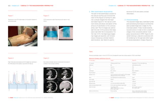 Chapter 20 | CARDIAC CT: THE RADIO­GRAPHERS’ ­PERSPECTIVE 203202 Chapter 20 | CARDIAC CT: THE RADIO­GRAPHERS’ ­PERSPECTIVE
THE HEART REVEALED RADIOLOGY IN THE DIAGNOSIS AND MANAGEMENT OF CARDIAC CONDITIONSTHE HEART REVEALED RADIOLOGY IN THE DIAGNOSIS AND MANAGEMENT OF CARDIAC CONDITIONS
Figure 4
Non-iodine-contrast calcium scoring with the calcium
marked in the coronary arteries.
Figure 1
Placement of the ECG electrodes on the patient placed on
the scanner bed.
Figure 2
Heart rate planning prospective ECG triggering, scanning in
the 75% phase of the cardiac cycle and R-R interval.
Figure 3
CCTA acquisition planning showing the field of view
(FOV).
A B
2.	 Main examination (acquisition):
This part of the examination consists of
the calcium scoring scan (CS) and the
main CCTA (Figure 3). During CS, plain
non-contrast images from the heart
are made (Figure 4). The calcium score
scan shows and allows calculation of the
amount of calcification in the coronary
artery wall. The CS images are used to
plan the main CCTA protocol that takes
place right after the CS acquisition. For
the main CCTA, the heart-beat-trigger-
ing images are acquired, with simulta-
neous intravenous contrast medium
administration. See Table for specific
technical CCTA and iodine contrast
information.
3.	 Post-processing:
The acquired image data undertake further
post-processing techniques to achieve the
best possible diagnostic images for the
individual patient. These include iterative
reconstructions in order to form a series of
images of the coronaries arteries’ multi-
planar reconstruction (MPR, Figure 5) and
vessel tracking is used and combined with
3D rendering, fly-through and other types
of vessel presentation images (Figure 6).
Table
Protocol examples used in clinical CCTA for an average 60-year-old cardiac patient (175cm and 90kg)
INDICATIVE TECHNICAL PROTOCOLS FOR CCTA
CT technique Greece Denmark
CT scanner Toshiba Aquilion Prime Revolution CT from GE Healthcare
Detectors 80 256 Gemstone (GSI)
kV Auto-kV 100
mA Auto-mA 412
Collimation 80 x 0.5mm 256 x 0.625mm
Slice thickness 0.5mm 0.625mm
Rotation time Auto, according to pitch selection from breath
exercise prior to CCTA (~0.35 sec)
0.28 sec
Pitch Auto adjusted from breath exercise Axial
Scan length 120mm 140mm
Scanning time 4 sec 0.28 sec
Effective dose 2-4 mSv (according to heart rate) 1–1.3 mSv
Iodine contrast protocol flow 5-6 mL/sec (according to heart rate) 6 ml/sec
Iodine contrast According to BMI
Approx. 90mL iodine contrast /
50 mL saline flash
60 ml iodine contrast /
50 ml salty water
Iodine contrast timing Bolus tracking Scan in smart prep mode, contrast
tracked manually and scan started
R R RR
 