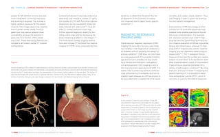 Chapter 22 | CARDIAC IMAGING IN RADIOLOGY – THE EFOMP PERSPECTIVE 223222 Chapter 22 | CARDIAC IMAGING IN RADIOLOGY – THE EFOMP PERSPECTIVE
THE HEART REVEALED RADIOLOGY IN THE DIAGNOSIS AND MANAGEMENT OF CARDIAC CONDITIONSTHE HEART REVEALED RADIOLOGY IN THE DIAGNOSIS AND MANAGEMENT OF CARDIAC CONDITIONS
dynamics to determine the blood flow for
all segments of the coronary circulation
non-invasively and to depict lesion specific
ischaemia20, 21
.
MAGNETIC RESONANCE
IMAGING (MRI)
Cardiovascular magnetic resonance (CMR)
imaging has become a routinely used imag-
ing modality in the diagnosis of cardiovascu-
lar diseases without exposing the patient to
ionising radiation22
. CMR does not only make
accurate assessment of myocardial morphol-
ogy and function possible, but also shows
focal fibrosis and infiltration. Late gadolin-
ium-enhancement (LGE) imaging is one of
the most important applications of CMR. It is
widely used in predicting adverse cardiovas-
cular outcomes e.g. in ischaemic and non-is-
chaemic heart diseases as LGE has proved to
be associated with increased risk of all-cause
mortality and sudden cardiac deaths23
. Thus,
LGE imaging is used to guide risk stratifica-
tion and patient management.
Improvements in MRI technology and the
introduction of novel MRI sequences have
enabled more reliable quantitative myocar-
dial tissue characterisation. For example,
pre- and post-contrast pixel-wise T1 map-
ping has become a promising technique for
non-invasive evaluation of diffuse myocardial
fibrosis and inflammation, whereas T2 map-
ping and T2* mapping are used for oedema
imaging and iron deposition determinations
respectively24–27
. The T1 relaxation time (a
measure of how fast the nuclear spin magne-
tisation recovers back to its equilibrium state
after a radiofrequency pulse) of myocardium
is becoming an essential biomarker for a
variety of pathological conditions24
. By using
both pre- and post-contrast T1 mapping and
patient haematocrit, it is possible to deter-
mine extracellular volume (ECV), which in
turn aims to quantify the relative expansion
phases for left ventricle function and wall
motion evaluation, continuous exposure
and scanning is required. This involves a
higher radiation exposure for the patient.
However, if the image data is only required
from a certain cardiac phase, the ECG-
gated scan may reduce radiation dose
considerably, because the exposure is
given only for a fraction of the overall
scan time5
. These dose saving features are
included in all modern cardiac CT scanner
configurations.
Contrast-enhanced CT provides anatomical
data and it may extend to cardiac CT perfu-
sion studies (CCTP) with functional stenosis
assessment during vasodilation stress typ-
ically induced with adenosine15, 16
. Dual-en-
ergy CT cardiac perfusion scans may
further improve diagnostic quality by pro-
viding iodine maps and by decreasing the
beam hardening artefacts in the images17–19
.
The more recent cardiac imaging applica-
tions also include CT fractional flow reserve
imaging (CT-FFR) using computational flow
A
C
B
D
Figure 1
Volume renderings of the cardiac CT data showing an anomaly where all coronary arteries begin from the right coronary cusp
and the left main branch follows the interarterial route between the pulmonary branch and the aorta. Accurate 3D representa-
tion during the CT examination facilitates the interpretation of the complex cardiac anatomy for the clinicians. The cardiac CT
scan was performed with a dual-source CT scanner (120 kVp, CTDIvol 11 mGy, DLP 190 mGycm, effective dose 3 mSv, 75 ms
temporal resolution, 55 bpm pulse rate). Images courtesy of Dr. Sari Kivistö, HUS Medical Imaging Center, Finland.
A B
Figure 2
A pre-contrast T1 map (A), post-contrast T1 map (B),
calculated ECV map (C) and LGE image (D) of a patient
with suspected sarcoidosis. 3T CMR examination revealed
hypertrophy in the anterior septum, and in the same area,
a large enhancement in LGE image was seen (marked
with *). The post-contrast T1 map showed significantly
decreased T1 relaxation time (~220 ms) in this area of the
myocardium compared to the normal myocardium (~520
ms). The corresponding ECV was increased up to a value
of 75, whereas ECV was less than 30% in the normal
myocardium. Patient haematocrit was 42%. Images were
acquired in HUS Medical Imaging Center, Finland.
 
