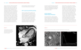 Chapter 1 | BASIC BUILDING BLOCKS IN NON-INVASIVE CARDIAC IMAGING 23
THE HEART REVEALED RADIOLOGY IN THE DIAGNOSIS AND MANAGEMENT OF CARDIAC CONDITIONS
22 Chapter 1 | BASIC BUILDING BLOCKS IN NON-INVASIVE CARDIAC IMAGING
THE HEART REVEALED RADIOLOGY IN THE DIAGNOSIS AND MANAGEMENT OF CARDIAC CONDITIONS
signal. Furthermore, SSFP also quantifies
chamber volume and LV mass; for that
purpose, a stack of short-axis SSFP cine
sequences should be acquired from the
annulus to the apex. Interobserver and
intraobserver variability is around 5% and
3% respectively for volume quantification.
Expert consensus panels consider CMR
to be the most precise and reproducible
technique to assess LV volume, mass and
ejection fraction. Other cardiac chamber
volumes can also be assessed using SSFP
sequences. Cine sequences are the basis
of all cardiac magnetic resonance images
(Figure 2). Besides the functional param-
eters, cine sequences can also depict
abnormal segmental contraction or any
abnormal aspect of the left ventricle such
as excessive trabeculation phenotypes.
MR FLOW QUANTIFICATION
Velocity-encoded cardiac magnetic reso-
nance measures flow in vessels of the car-
diovascular system without the use of intra-
vascular catheterisation, ionising radiation
radioactive tracers or gadolinium injection.
Velocity maps are generally displayed on
a grey scale with stationary tissue shown
in mid-grey, velocities in forward (positive)
and reverse (negative) directions being
represented as higher (towards white)
Figure 2
This figure shows a four chamber
view steady state free precession
(SSFP) image in the diastolic phase.
Note the high contrast between
blood and myocardium.
Figure 3
This figure shows velocity-encoded images in (A) and the corresponding aortic flow profile in (B).
A B
and lower (towards black) pixel intensities
(Figure 3). Velocity-encoded CMR meas-
ures valvular regurgitation accurately and
is used if echocardiography has yielded
unsatisfactory results.
MYOCARDIAL
PERFUSION IMAGING
Myocardial perfusion imaging assesses
the blood supply to the myocardium and
plays an increasing role in the diagnosis of
ischaemic heart disease. In order to assess
myocardial perfusion, blood passing into
the myocardium needs to alter the image
signal intensity so that areas of reduced
perfusion can be detected. This is typically
achieved using a signal enhancing con-
trast agent. The contrast agent is injected
intravenously whilst multiple images of the
heart in the same anatomical position and
at the same point in the cardiac cycle are
acquired in successive heartbeats. Typi-
cally, short-axis images are acquired but a
long axis image is sometimes also acquired
in order to cover the apex of the heart.
In general, the acquisition of a dynamic
series of MR images during the passage
of contrast agent through the body is
known as dynamic contrast-enhanced MRI
(DCE-MRI). DCE-MRI can be used after the
injection of a vasodilator drug at rest and
 