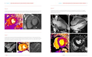 Chapter 1 | BASIC BUILDING BLOCKS IN NON-INVASIVE CARDIAC IMAGING 27
THE HEART REVEALED RADIOLOGY IN THE DIAGNOSIS AND MANAGEMENT OF CARDIAC CONDITIONS
26 Chapter 1 | BASIC BUILDING BLOCKS IN NON-INVASIVE CARDIAC IMAGING
THE HEART REVEALED RADIOLOGY IN THE DIAGNOSIS AND MANAGEMENT OF CARDIAC CONDITIONS
Figure 7
This figure shows a patient with overall myocardial hypertrophy involving the left ventricular (LV), right ventricular (RV) and
both atrial walls on (A). On (B) the T1 map shows high signal intensity of the entire LV whole with a T1 value measured at 1542ms
(normal 1150ms (3T machine)). The LGE image in (C) depicts diffuse myocardial enhancement with a higher signal in compari-
son to LV blood. Amyloidosis was confirmed on biopsies.
Figure 8
This figure shows a patient with a global disseminated left ventricular (LV) hypertrophy in (A) and (B). In (C) T1 mapping
revealed a low value at the level of the septum with a T1 value measured at 798ms and a high signal area on the lateral wall
matching with area of LGE on (D).
A B C
A
C
B
D
Figure 6
This figure shows a patient with an acute cardiac sarcoidosis involvement depicted by a large oedema shown as an orange area
on the T2 mapping sequence in (A) and matching with the late gadolinium enhancement (LGE) myocardial area on (B).
A B
 