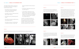 Chapter 4 | CARDIAC CT IN THE ­EMERGENCY ROOM 5352 Chapter 4 | CARDIAC CT IN THE ­EMERGENCY ROOM
THE HEART REVEALED RADIOLOGY IN THE DIAGNOSIS AND MANAGEMENT OF CARDIAC CONDITIONSTHE HEART REVEALED RADIOLOGY IN THE DIAGNOSIS AND MANAGEMENT OF CARDIAC CONDITIONS
obstructive disease) ACS likely (Figures 5
and 6)
−− CAD-RADS 5 (100% total occlusion) ACS
very likely (Figure 7)
−− A CAD-RADS N is reserved for non-di-
agnostic studies. Some factors are taken
into account and added to the category as
modifiers, which include not fully evaluable
(N), stent (S) (Figure 8), graft (G) (Figure
9), vulnerable plaque (V)
Coronary CTA provides information not
only for coronary arteries, but also allows
to evaluate the structure of the cardiac
chambers, integrity of atrial and ventricu-
lar septum, aorta (Figure 10), pericardium,
pulmonary vessels and lungs. There is a
CAD-RADS classifies cardiac CT results into
five categories depending on the degree of
maximal coronary stenosis:
−− CAD-RADS 0 confirms the absence of
coronary artery disease (0% stenosis)
ACS highly unlikely (Figure 2)
−− CAD-RADS 1 (minimal, 1–24% stenosis) ACS
highly unlikely (Figure 3)
−− CAD-RADS 2 (mild, 25–49% stenosis) ACS
unlikely
−− CAD-RADS 3 (moderate, 50–69% stenosis)
ACS possible (Figure 4)
−− CAD-RADS 4A (severe, 70–99% stenosis)
or 4B (left main >50% or 3-vessel >70%
Figure 2
47-year-old male, acute chest pain, low risk for ACS. (A) Cinematic rendering, (B) Curved planar reconstructions and
cross-section of RCA, LAD and LCX, shows normal coronary arteries with no plaque or stenosis (CAD-RADS 0).
A B
Figure 3
60-year-old male, acute chest pain, intermediate risk for
ACS. (A) VRT of coronary tree shows multiple calcified
plaques in coronary arteries. Calcified plaques with minimal
stenosis in (B) RCA, (C) LAD and (D) LCX.
Figure 4
Two different patients with acute chest pain. (A) Obtuse
marginal branch with non-calcified plaque with 50–69%
moderate stenosis (yellow arrow), (B) Mid segment RCA
with partially calcified plaque with 50-69% moderate ste-
nosis (green arrow).
A
A
C
B
B
D
Figure 5
56-year-old male, stable chest pain. (A) VRT of coronary tree
shows high take-off of RCA (yellow arrow), anomalous origin
of LCX from right sinus of Valsalva with retroaortic course
(red arrow), LAD from left sinus of Valsalva (blue arrow).
(B) CPR of RCA shows high take-off (yellow arrow), severe
stenosis in distal RCA (orange arrow) and PDA (green arrow),
(C) subocclusive predominant non-calcified plaque in mid
LAD (blue arrow), (D) retroaortic LCX with diffuse partially
calcified plaques with severe stenosis (red arrow). 3 vessel
obstructive disease (CAD-RADS 4B).
A B
Figure 6
61-year-old female, recurrent chest pain even after recent stent
placement. (A) MIP and (B) VRT shows severe stenosis of LM
(yellow arrow), stent in proximal LAD (green arrow), severe
reduced flow in mid LAD (blue arrow). (CAD-RADS 4B/S).
A
C
B
D
 