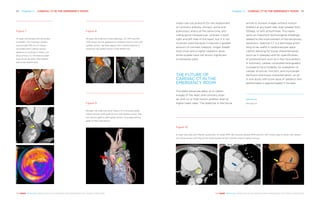 Chapter 4 | CARDIAC CT IN THE ­EMERGENCY ROOM 5554 Chapter 4 | CARDIAC CT IN THE ­EMERGENCY ROOM
THE HEART REVEALED RADIOLOGY IN THE DIAGNOSIS AND MANAGEMENT OF CARDIAC CONDITIONSTHE HEART REVEALED RADIOLOGY IN THE DIAGNOSIS AND MANAGEMENT OF CARDIAC CONDITIONS
triple-rule-out protocol for the assessment
of coronary arteries, thoracic aorta and
pulmonary artery at the same time, pro-
viding good intravascular contrast in both
right and left side of the heart, but it is not
routinely used because it requires a greater
amount of contrast medium, longer breath
hold times and a higher radiation dose,
while studies have not shown significant
incremental yield.
THE FUTURE OF
CARDIAC CT IN THE
EMERGENCY ROOM
The latest advances allow us to obtain
images of the heart and coronary arter-
ies with no or little motion artefact even at
higher heart rates. The objective in the future
will be to achieve images without motion
artefact at any heart rate, even greater than
100bps, or with arrhythmias. This repre-
sents an important technological challenge
related to the improvement of the temporary
resolution. Spectral CT is a technique prom-
ising to be useful in cardiovascular appli-
cations allowing for tissue characterisation
(such as in plaques) and for quantification
of enhancement such as in the myocardium.
In summary, cardiac computed tomography
is posed to be a modality for evaluation of
cardiac structure, function, and myocardial
perfusion and tissue characterisation, an all
in one study with a low dose of radiation and
performable in approximately 5 minutes.
References
See page 231
Figure 8
55-year-old male with chest tightness. (A) VRT and (B)
CPR shows normal appearance of patent stent in mid LAD
(yellow arrow), calcified plaque with minimal stenosis in
proximal LAD (green arrow) (CAD-RADS 1/S).
Figure 9
69-year-old male with prior history of 3 coronary grafts.
Patent arterial LIMA graft to mid LAD (yellow arrow). Pat-
ent venous graft to OM1 (green arrow). Occluded venous
graft to PDA (red arrow).
A B
Figure 10
21-year-old male with Marfan syndrome. (A) axial MPR, (B) coronal oblique MPR and (C) VRT shows type A aortic root dissec-
tion (blue arrow) with flap at the ostial border of left coronary artery (yellow arrow).
A B C
Figure 7
70-year-old female with shortness
of breath. (A) Cinematic render-
ing and (B) CPR of LCX shows
occluded stent (yellow arrow),
absence of contrast in distal LCX
(blue arrow), (C) thickening polar
map shows akinetic inferolateral
wall (CAD-RADS 5/S).
A
B
C
 