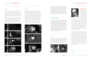 Chapter 5 | THE ISCHAEMIC HEART 6362 Chapter 5 | THE ISCHAEMIC HEART
THE HEART REVEALED RADIOLOGY IN THE DIAGNOSIS AND MANAGEMENT OF CARDIAC CONDITIONSTHE HEART REVEALED RADIOLOGY IN THE DIAGNOSIS AND MANAGEMENT OF CARDIAC CONDITIONS
yet be used in MRI. Also, there is a large and
old amount of scientific evidence pleading for
gated SPECT. Many cardiologists still consider
MRI as a research tool. Finally, cardiac MRI is
insufficiently recognised and reimbursed by
health systems in Western countries and this is
probably one of the most problematic features.
CONCLUSION
In summary, nowadays a stress cardiac MRI is a
safe alternative to other stress tests in cardiol-
ogy used to detect ischaemia. The examination
is quite short, requires the use of a vasodilator
drug and its diagnostic capabilities are excellent.
The limited costs, the absence of radioactive
effluent and the absence of radiation are unique
advantages of cardiac MRI over gated SPECT.
Cardiac MR should definitely be employed more
often by cardiologists worldwide.
Figure 2
Abnormal stress perfusion imaging in a 48-year-old
male patient complaining of chest pain while exercising.
Systolic function was impaired (ejection fraction: 35%).
Stress perfusion imaging showing decreased signal in the
sub endocardium of the inferior basal segments (right
coronary artery territory) (green arrows) (A). Vasodilation
had been obtained after intravenous injection of 400 μg
Regadenoson for 10 seconds. Subsequent rest perfusion
(B) after an injection of 125mg IV aminophylline was
normal. Delayed enhancement did not show scarring (C).
Percutaneous angioplasty of the right coronary artery
was performed. Six months later, the patient was free of
symptoms and ejection fraction had increased by 7%.
A
B
C
Figure 3
This 32-year-old man with a long history of hypertension was
referred to CT for chest pain. A severe dual stenosis of the left
anterior descending artery (LAD) was disclosed (A). Stress
MR (400 μg Regadenoson) was positive in the apical septum
(B). Based on this result, revascularisation was performed.
A B
A
B
C
D
Figure 1
Normal stress perfusion imaging in a 45-year-old female
patient with chest pain and normal systolic function. Vas-
odilation occurred after an intravenous injection of 400 μg
Regadenoson for 10 seconds. Heart rate increased from 70
to 90 beats per minute. Four successive short axis views
of the same dynamic sequence (saturation recovery) are
shown.
(A) Baseline image (prior to gadolinium chelate bolus).
(B) Enhancement of the right ventricle. (C) Enhancement
of the left ventricle and lung. (D) Synchronous (normal)
enhancement of the myocardium. Both CINE and delayed
enhancement pulse sequence (not shown) were normal.
PROF. JEAN-NICO-
LAS DACHER
is a French cardiac
radiologist appointed
as Professor of Radi-
ology by the Univer-
sity of Normandy in
Rouen since 1999. He
is practising cardiac
MR and CT and devotes a significant part of his
time to the evaluation of congenital heart disease
(CHD) in children and adults. This particular inter-
est in CHD relates to his initial training in paediat-
ric radiology. Professor Dacher is also interested
in imaging of the myocardium, coronary artery
disease and valvular heart disease (Rouen is the
place where Alain Cribier performed the first
in-man transarterial implantation of aortic pros-
thesis (TAVR) in 2002).
Professor Dacher is a member of the Société
Française de Radiologie (SFR), Société Française
d’Imagerie Cardiovasculaire (SFICV), European
Society of Radiology (ESR) and European Soci-
ety of Cardiovascular Radiology (ESCR). Author
of 200 articles referenced in PubMed and several
book chapters, Jean-Nicolas Dacher is an active
teacher of cardiac imaging in the French-speak-
ing community and outside it. Currently, he acts
as a member of the Cardiac Scientific Committee
of European Radiology and Diagnostic and Inter-
ventional Imaging.
References
See page 231
 
