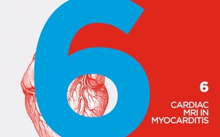 6
CARDIAC
MRI IN
­MYOCARDITIS
 