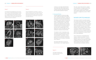 Chapter 6 | CARDIAC MRI IN MYOCARDITIS 6968 Chapter 6 | CARDIAC MRI IN MYOCARDITIS
THE HEART REVEALED RADIOLOGY IN THE DIAGNOSIS AND MANAGEMENT OF CARDIAC CONDITIONSTHE HEART REVEALED RADIOLOGY IN THE DIAGNOSIS AND MANAGEMENT OF CARDIAC CONDITIONS
In practice, cine images obtained follow-
ing contrast often demonstrate areas of
increase myocardial signal reflecting EGE
and myocardial hyperaemia (Figure 1).
4.	 Necrosis/Fibrosis
Late post gadolinium enhanced images
(LGE) visualise the presence and distribu-
tion of myocardial scar/fibrosis. Images are
obtained 8–10 minutes after administration
of contrast using an inversion-recovery pre-
pared T1 weighted sequence to suppress
normal myocardial signal. In theory high
signal on LGE images denotes irreversible
myocardial necrosis and scarring, however,
in practice, areas of myocardial oedema
may also show increased signal on LGE
sequences in acute myocardial injury with
subsequent resolution during recovery.
The pattern of LGE in myocarditis is typ-
ically patchy and predominantly involves
the sub-epicardial myocardium and the
mid myocardium. Importantly, it usually
spares the sub-endocardium allowing dif-
ferentiation from an ischaemic myocardial
injury (Figure 2).
Pericardial inflammation may also be
demonstrated on LGE images (Figure 3).
Figure 3
LGE images showing pericardial
enhancement consistent with peri-
carditis (white arrows).
A B
Figure 1
This illustrates the typical appearances of acute myocar-
ditis. (A) SSFP cine image following gadolinium showing
areas of increased signal indicating hyperaemia. (B) and
(C) T2 weighted images showing increased myocardial
signal compared to skeletal muscle indicating myocardial
oedema. (D) and (E) LGE images showing a diffuse mid
myocardial scar typical of myocarditis.
A
C
E
B
D
Figure 2
Typical LGE appearances of myocarditis in 3 cases (A)
and (B), (C) and (D), (E) and (F), with patchy areas of scar
sparing the subendocardium (white arrows). Conversely
case (G) and (H) shows an inferior wall MI with transmural
and subendocardial scar (white arrows) in a typical coro-
nary territory distribution.
A
C
E
G
F
H
B
D
The Lake Louise Criteria allow for a diagno-
sis of myocarditis in the appropriate clinical
context if two or more of the diagnostic
tissue markers (oedema, EGE or typical scar)
are present. A diagnostic accuracy of 78% is
quoted.
NEWER CMR TECHNIQUES
Techniques to identify myocardial oedema
are currently hampered by issues with signal
to noise ratio and image quality. In addition,
myocardial oedema is often diffuse, making it
difficult to visualise as all of the myocardium
may be affected. The Lake Louise Criteria
therefore used the degree of signal intensity
compared to adjacent skeletal muscle as a
quantitative cut off for myocardial oedema.
Likewise, the distribution of EGE may be very
diffuse and subsequently not easily discerni-
ble to visual assessment.
The re-introduction of quantitative tech-
niques to measure myocardial T1 and T2
relaxation times in the form of ‘parametric
mapping’ sequences has significantly added
to diagnostic accuracy as they are able to
identify global (and regional) changes in
myocardial signal with greater sensitivity.
 