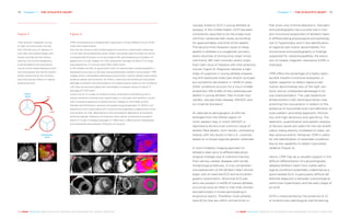 Chapter 7 | THE ATHLETE’S HEART 7978 Chapter 7 | THE ATHLETE’S HEART
THE HEART REVEALED RADIOLOGY IN THE DIAGNOSIS AND MANAGEMENT OF CARDIAC CONDITIONSTHE HEART REVEALED RADIOLOGY IN THE DIAGNOSIS AND MANAGEMENT OF CARDIAC CONDITIONS
causally linked to SCD in young athletes at
autopsy. In the United States, HCM has been
consistently reported to be the single most
common cardiovascular cause, accounting
for approximately one third of the deaths.
The second most frequent cause of these
deaths in athletes is a congenital coronary
artery anomaly of wrong sinus origin (most
commonly, left main coronary artery origin
from right sinus of Valsalva with inter-arterious
course; Figure 3). Diagnosis requires a high
index of suspicion in young athletes present-
ing with exertional chest pain and/or syncope,
but symptoms are present in <50% of cases.
Other conditions account for a much smaller
proportion (5% to 8%) of the cardiovascular
deaths in young athletes: they include myo-
carditis, valvular heart disease, ARVD/C and
ion-channel disorders3
.
An alternative demographic profile has
emerged from the Veneto region of
north-eastern Italy, in which ARVD/C is
reported to be the most common cause of
athletic field deaths. Such results, contrasting
sharply with the results in the U.S., could be
based on a unique regional genetic substrate.
A multi-modality imaging approach to
athlete’s heart aims to differentiate physi-
ological changes due to intensive training
from serious cardiac diseases with similar
morphological features. A truly comprehen-
sive assessment of the athlete’s heart should
begin with an exercise ECG and echocardio-
graphic examination. Abnormal ECG pat-
terns are present in ≈40% of trained athletes,
occurring twice as often in men than women,
and particularly in those participating in
endurance sports. Therefore, most athletes
have ECGs that are within normal limits or
that show only minimal alterations. Standard
echocardiography has a pivotal role in mor-
pho-functional assessment of athlete’s heart,
in differentiating physiological and patholog-
ical LV hypertrophy and in the identification
of regional wall motion abnormalities. For
inconclusive echocardiography or findings
suspected for cardiomyopathies, the execu-
tion of cardiac magnetic resonance (CMR) is
indicated.
CMR offers the advantage of a highly repro-
ducible morpho-functional evaluation, a
higher capability to detect regional wall
motion abnormalities also of the right ven-
tricle, and an undisputed advantage in tis-
sue characterisation. The Late Gadolinium
Enhancement (LGE) technique allows char-
acterising the myocardium in relation to the
presence of myocardial scars and definition of
scars pattern, providing diagnostic informa-
tion with high sensitivity and specificity. The
detection, quantification and pattern analysis
of fibrosis results are useful for the risk stratifi-
cation, being directly correlated to major car-
diac adverse events. Moreover, CMR is useful
for the identification of reversible conditions
due to the capability to detect myocardial
oedema (Figure 4).
Hence, CMR may be a valuable support in the
difficult differentiation of a physiologically
adapted athlete’s heart from subtle patho-
logical conditions potentially underlined as a
sport-related SCD. A particularly difficult dif-
ferential diagnosis is between a physiological
ventricular hypertrophy and the early stage of
an HCM.
HCM is characterised by the presence of LV
or biventricular pathological wall thickening
Figure 3
‘Inter-arterial’ malignant course
of right coronary artery arising
from the left sinus of Valsalva in
a 16-year-old football player with
recent syncope during intense
training. Functional malignancy
is attributable to the anomalous
course of the vessel leading to arte-
rial compression during the systolic
phase, enhanced by the inotropic
and chronotropic effect of intense
physical activity.
Figure 4
CMR comprehensive multiparametric approach in three different forms of left
ventricular hypertrophy.
Top row (A) shows a case of physiological concentric hypertrophy observed
in a 27-year-old professional rower (mean myocardial wall thickness 12–14mm).
Increased wall thickness is not associated with pathological accumulation of
gadolinium on LGE images nor with substantial changes of native T1 on map-
ping sequences (T1 normal value: 950–1000 msec).
In the middle row (B), an asymmetric form of hypertrophic cardiomyopathy is
displayed occurring in a 26-year-old asymptomatic amateur tennis player. CMR
images show a remarkable pathological asymmetric anterio-septal hypertrophy
(anterior-septal wall thickness: 16–21mm), matching with extensive myocardial
damage consistent with the presence of multiple patchy areas of non-ischaemic
LGE (see arrows) associated with remarkably increased values of native T1
(average of 1,176 msec).
Lower row (C) is a case of cardiac primary amyloidosis manifesting with a
severe concentric biventricular hypertrophy in a 42-year-old marathon runner
with occasional depiction of abnormal low voltage on limb leads at ECG.
Parietal wall thickness is severely increased (ranging between 12–16mm in all
segments), and is associated with a typical inhomogeneous appearance of the
myocardium on LGE, depending on the extracellular deposition of amorphic
amyloid material. Presence of extensive intra-cellular amyloid accumulation.
Native T1 is also increased (average of 1,289 msec), reflecting the widespread
and substantial extracellular infiltration of amyloid.
A
C
B
Aortic
valve
pulmonary
valve
RCA
LAD
CX
 