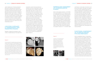 Chapter 8 | IMAGING OF CORONARY ARTERIES 8988 Chapter 8 | IMAGING OF CORONARY ARTERIES
THE HEART REVEALED RADIOLOGY IN THE DIAGNOSIS AND MANAGEMENT OF CARDIAC CONDITIONSTHE HEART REVEALED RADIOLOGY IN THE DIAGNOSIS AND MANAGEMENT OF CARDIAC CONDITIONS
MORPHOLOGIC ASSESSMENT
OF ATHEROSCLEROTIC
PLAQUE
Given its high spatial resolution, CCTA offers
the unique potential to non-invasively visual-
ise, characterise and quantify atherosclerotic
plaque15
. The notion of vulnerable plaques is
a rather complex concept; however specific
high-risk plaque features can be identified
on standard CCTA datasets. Several adverse
features associated with vulnerable plaques
have already been identified and include the
presence of positive remodelling, low-atten-
uation plaque, spotty calcifications and the
napkin ring sign (see a typical low-attenua-
tion plaque in Figure 3) 16–19
. In contrast, larger
calcification is more likely to be found in sta-
ble coronary lesions. Although the evidence
is still very limited, detailed assessment of
plaque morphology for the presence of high-
risk plaque features in patients presenting
to the ED with acute chest pain but nega-
tive initial electrocardiogram and troponin
provides incremental diagnostic value as the
presence of high-risk plaque increases the
likelihood of ACS, independent of significant
CAD and clinical risk assessment, including
age, sex, and number of cardiovascular risk
factors20
. Thus, identification of such high-risk
plaques may improve risk estimates for the
individual patient and may be of use in the
selection of patients who could benefit from
revascularisation.
FUNCTIONAL ASSESSMENT
OF ATHEROSCLEROSIS:
FFR AND PERFUSION
Given its established value in morphologic
imaging of CAD, much research efforts over
the last years have focused on providing
information beyond the assessment of cor-
onary stenosis and plaque. To date, CCTA
offers two different approaches to assess
the functional relevance of a given stenosis:
a) myocardial perfusion imaging and b) the
calculation of a CT-based fractional flow
reserve (CT-FFR). CT myocardial perfusion
is based on the first-pass effect of iodinated
contrast media through the myocardium
during vasodilator stress (pharmacologically
induced using regadenoson, adenosine, or
dipyridamole). The study can either be per-
formed by obtaining one single scan during
maximum enhancement (also referred to as
acquisitions, given that high anatomical
resolution with short examination times can
be combined with low radiation exposure.
Specifically, high-pitch CT (pitch >3), low
kV (as low as 70 kV), and iterative recon-
struction algorithms have resulted in cardi-
ovascular exams with radiation exposure of
<1 mSv13
. Nowadays, for a detailed visual-
isation of the cardiac anatomy, ECG-trig-
gered protocols are recommended,
although it has also been demonstrated
that the detection of the coronary arteries
even in a non-ECG-triggered spiral mode
with high temporal resolution is possible14
.
Most paediatric cases will be scanned in a
prospective ECG-triggered sequential scan
(‘step-and-shoot mode’) or high-pitch scan
whereas retrospective ECG-gating should
be avoided due to high radiation exposure
(see a low dose coronary CT angiography
of a 6-month-old girl with Kawasaki Dis-
ease in Figure 2).
useful imaging tool in the pre-procedural
planning of cardiovascular interventions,
providing improved success rates for revas-
cularisation and post-procedural outcome
after percutaneous techniques10
. Besides its
diagnostic value, there is also an increasing
role of CCTA to predict cardiovascular risk
over time, as several follow-up studies report
an excellent prognosis for patients negative
in CCTA for any CAD or coronary athero-
sclerosis, whereas outcome in patients with
obstructive and also non-obstructive CAD is
substantially worse11, 12
.
LOW DOSE CORONARY
CT ANGIOGRAPHY AND
PAEDIATRIC IMAGING
Paediatric imaging has emerged as a par-
ticularly valuable setting for low dose CCTA
Figure 2
6-months-old girl with Kawasaki disease and suspected
coronary artery aneurysms in echocardiography. Coronary
CT scanned in ECG-gated high-pitch mode revealed aneu-
rysms in the right coronary artery (RCA; white arrow) and
the left anterior descending artery (LAD; white arrowhead).
Note the good image quality despite an average heart rate
of 154 beats per minute. Scan parameters: 70 kVp, 149 eff.
mAs with automated dose-modulation leading to a DLP of
5.8 mGy*cm resp. an effective dose of 0.5 mSv. (A) curved
multi-planar reconstruction (MPR) of the RCA; (B) curved
MPR of the LAD; (C) Volume rendering technique (VRT) of
the heart with view on the RCA; (D) VRT of the heart with
view on the LAD.
A
A B
C
B
D
Figure 3
Coronary CT of an atherosclerotic
plaque in the LAD, demonstrat-
ing high-risk plaque features,
including low-attenuation and
positive remodelling in the prox-
imal segment of the left anterior
descending coronary artery. (A)
curved multiplanar reformat and
corresponding cross-section of the
vessel (B).
 