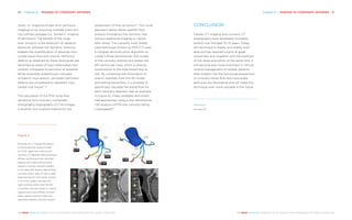 Chapter 8 | IMAGING OF CORONARY ARTERIES 9190 Chapter 8 | IMAGING OF CORONARY ARTERIES
THE HEART REVEALED RADIOLOGY IN THE DIAGNOSIS AND MANAGEMENT OF CARDIAC CONDITIONSTHE HEART REVEALED RADIOLOGY IN THE DIAGNOSIS AND MANAGEMENT OF CARDIAC CONDITIONS
CONCLUSION
Cardiac CT imaging and coronary CT
angiography have developed incredibly
quickly over the past 10–15 years. Today,
this technique is readily and widely avail-
able and has reached a point of great
robustness and, together with the potential
of low-dose acquisition at the same time, it
will become ever more important in clinical
routine management of cardiac patients.
New insights into the functional assessment
of coronary blood flow and myocardial
perfusion are fascinating and will make this
technique even more valuable in the future.
References
See page 232
‘static’ or ‘snapshot/single-shot’ perfusion
imaging) or by acquiring multiple scans dur-
ing contrast passage (i.e. ‘dynamic’ imaging
of perfusion). The benefit of the ‘snap-
shot’ protocol is the reduction of radiation
exposure, whereas the ‘dynamic’ protocol
enables the quantification of absolute myo-
cardial blood flow and volume. Perfusion
defects as obtained by these techniques are
identified as areas of hypo-attenuated myo-
cardium compared to perfusion at baseline.
While reversible malperfusion indicates
ischaemic myocardium, persistent perfusion
defects are considered to represent myo-
cardial scar tissue21, 22
.
The calculation of the FFR using flow
dynamics from coronary computed
tomography angiography (CCTA) images
is another non-invasive method for the
assessment of flow dynamics23
. This novel
approach allows lesion-specific flow
analysis throughout the coronary tree
without additional imaging or vasodi-
lator stress. The currently most widely
used technique (known as FFR-CT) uses
a complex reconstruction algorithm to
create a three-dimensional (3D) model
of the coronary arteries and assess the
left ventricular mass, which is directly
proportional to the total blood flow at
rest. By combining the information of
branch diameter from the 3D model
and resting blood flow, it is possible to
specifically calculate the blood flow for
each coronary segment (see an example
in Figure 4). Freely available and simpli-
fied approaches using a one-dimensional
(1D) analysis (cFFR) are currently being
investigated24
.
Figure 4
Example of a CT-based derivation
of fractional flow reserve model
(CT-FFR, upper bar) and source
coronary CT datasets demonstrating
diffuse calcified and non-calcified
plaques with haemodynamically
relevant coronary stenosis present
in the distal left anterior descending
coronary artery (also A) and a large
diagonal branch (red colour-coding
in the FFR model) whereas the
right coronary artery and the left
circumflex coronary artery (C and B,
respectively) have diffuse coronary
artery disease without haemody-
namically-relevant coronary lesions.
A B C
 