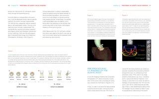 Chapter 10 | TREATMENT OF AORTIC VALVE STENOSIS 107106 Chapter 10 | TREATMENT OF AORTIC VALVE STENOSIS
THE HEART REVEALED RADIOLOGY IN THE DIAGNOSIS AND MANAGEMENT OF CARDIAC CONDITIONSTHE HEART REVEALED RADIOLOGY IN THE DIAGNOSIS AND MANAGEMENT OF CARDIAC CONDITIONS
PRE-PROCEDURAL
CT IMAGING OF THE
AORTIC ROOT
A true 3D imaging modality like computed
tomography (CT) allows exquisite visualis-
ation of the aortic root, providing all neces-
sary anatomical information (Figures 2–5).
Firstly, in order to achieve the best possible
outcome and avoid peri- and post-proce-
dural complications, the new THV must of
course fit the native anatomy as closely as
possible, avoiding the associated problems
arising from over- or undersizing of the
prosthetic valve. If the valve is too large,
several complications can occur, including
aortic rupture and device migration. Con-
versely, a valve that is too small can lead to
leakage of blood between the THV and the
aortic wall, the so-called paravalvular leak-
age. There is well-established evidence that
this leakage may be related, at least in part,
to preoperative undersizing of the aortic
partial mini-sternotomy for transaortic place-
ment through the ascending aorta.
Once the device is transported to the aortic
root, it will be deployed using a device-specific
method. All current clinically implemented
THV fall into two categories: balloon-expand-
able or self-expandable valves. The two most
used and most clinically implemented THV
worldwide are currently the balloon-expand-
able Sapien series from Edwards Lifesciences
(Irvine, California, USA) and the self-expand-
able Corevalve/Evolut range from Medtronic
(Minneapolis, Minnesota, USA) (Figure 1).
During deployment, a balloon-expandable
valve will expand using the radial strength of
the accompanying balloon, and commonly
force its circular design on the pre-existing
oval-shaped annular morphology. Conversely,
a self-expandable valve will deploy until it
encounters the resistance of the annular wall,
conforming itself to the mostly oval-shaped
anatomy of the aortic annulus.
After deployment, the THV will have crushed
the native valve against the aortic root wall, as
such functionally replacing the diseased valve
and restoring valve function.
Figure 1
Current available sizes of the two most commonly clinically implemented transcatheter heart valves, the Sapien series of
Edward Lifesciences (A) and the Corevalve/Evolut series of Medtronic (B). The indicated size ranges correspond to the required
aortic annulus diameter, assuming a circular morphology of this anatomic landmark. With the two models combined, a patient
is currently able to receive this kind of prosthetic heart valve when the annular diameter lies in the range of 16–29 mm. The
development of these devices is a continuous work in progress, and new models and sizes are already in the clinical test phase
in order to accommodate to the largest number of patients and to minimise the risk of complications associated with first-gen-
eration devices.
A B
Figure 2
3D volume-rendered image of the heart illustrating the
double-oblique orientation of the aortic root (asterisk).
The horizontal line corresponds to a true axial image as
acquired with CT. This figure clearly illustrates that, in
order to correctly obtain critical measurements required to
maximise procedural success, a re-orientation of the meas-
urement plane in a double-oblique fashion along the axis
of the aortic root is necessary. This is one of the reasons
that currently CT is considered an essential imaging tool,
improving pre-procedural planimetry of the annulus and
aortic root over conventional ultrasound measurements.
Figure 3
Composite image illustrating the crown-like configuration
of the aortic valve leaflets within the aortic root, extending
from the sino-tubular junction (blue) to the most basal
attachment plane, hereby defining the so-called annular
plane (green). The CT images on the right illustrate the
varying cross-sectional morphology of the aortic root,
being mostly circular at the level of the sino-tubular junc-
tion, but becoming more clover-leaf shaped at mid-level
and usually ending in an ellipsoid or oval morphology at
the annular level.
 