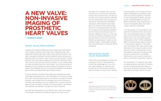 Chapter 11 | PROSTHETIC HEART VALVES 115
THE HEART REVEALED RADIOLOGY IN THE DIAGNOSIS AND MANAGEMENT OF CARDIAC CONDITIONS
associated risks. Prosthetic heart valve dys-
function may occur and known mechanisms
of dysfunction include thrombus formation on
the valve, pannus tissue ingrowth underneath
the valve causing obstruction, and structural
valve failure. The gravest and most feared
complication after prosthetic valve implan-
tation is an infection of the prosthetic heart
valve which is called endocarditis. The infec-
tion may lead to severe damage and destruc-
tion of the tissue surrounding the valve. Fur-
thermore, vegetations may form on the valve
that both can hamper valve leaflet motion as
well as embolise to other parts of the body
thereby causing abscesses in organs such as
the brain or spleen. Unfortunately, prosthetic
heart valve endocarditis is notoriously difficult
to diagnose.
PROSTHETIC HEART
VALVE ASSESSMENT
Traditionally, echocardiography has been the
technique of choice for valve assessment.
It offers many advantages as it is non-inva-
sive, readily available, non-expensive and
provides not only anatomical but also func-
tional information on valve function. However,
echocardiography has its limitations and the
artefacts generated by the prosthetic heart
valves may hamper assessment. Therefore,
in case of (suspected) prosthetic valve dys-
function, echocardiography can often not
determine the exact cause of dysfunction, or
in case of endocarditis, detect perivalvular
mycotic aneurysms or abscesses.
In the last decade, CT has emerged as a val-
uable tool for prosthetic heart valve assess-
ment, providing detailed anatomical assess-
ment as well as functional analysis of valve
leaflet motion1
. Most valve types generate
limited artefacts and CT offers unparalleled
detail of the (peri)valvular regions (Figure 1).
CT has earned its reputation in the assess-
ment of prosthetic heart valves and provides
information on the cause of prosthetic valve
dysfunction that is complementary to echo-
cardiography, especially since reduced dose
acquisition protocols are now available2
.
Furthermore, it can be used to monitor the
effects of treatment as illustrated in Figure 2.
For endocarditis, CT is especially well suited
to visualising mycotic aneurysms in the aortic
root and to demonstrating their relation to
the coronary arteries and extension towards
other parts of the heart. Positron emission
A NEW VALVE:
NON-INVASIVE
IMAGING OF
PROSTHETIC
HEART VALVES
BY RICARDO P.J. BUDDE
HEART VALVE REPLACEMENT
Hundreds of thousands of patients annually undergo heart valve replace-
ment to replace a defective native heart valve. Traditionally, heart valve
replacement required open heart surgery. After opening the sternum, the
heart is exposed and opened to excise the defective native valve and sub-
sequently implant a prosthetic valve. There are two main groups of surgical
prosthetic heart valve types: biological and mechanical. Mechanical valves
often have two semi-lunar discs that are mounted in a ring, whereas biolog-
ical valves are made of porcine or bovine tissue. The mechanical valves are
designed to last for decades but require lifelong anticoagulation with all its
inherent risks. Biological valves do not require anticoagulation but degener-
ate and need to be replaced after approximately 15 years.
In the last decade, a minimally invasive alternative procedure was devel-
oped called transcatheter aortic valve implantation (TAVI, see also chapter
10). In TAVI, the native aortic valve is not excised but a new stent-mounted
biological valve is placed within the diseased native valve. Since data on
long-term valve durability are not yet available TAVI is currently limited to
older and high-risk patients. However, with improvements in valve design,
it will likely also be employed in younger and lower risk patients.
Although valve replacement is a very effective way to treat valve disease,
it also presents the patient with artificial material in their heart with all
Figure 1
Three-dimensional volume-rendered CT image of two
mechanical prosthetic heart valves. Note the detail of the
valve that can be seen including the hinge points of the
valve leaflets.
 
