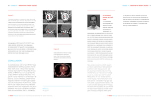 Chapter 11 | PROSTHETIC HEART VALVES 117116 Chapter 11 | PROSTHETIC HEART VALVES
THE HEART REVEALED RADIOLOGY IN THE DIAGNOSIS AND MANAGEMENT OF CARDIAC CONDITIONSTHE HEART REVEALED RADIOLOGY IN THE DIAGNOSIS AND MANAGEMENT OF CARDIAC CONDITIONS
Figure 2
Thrombus formation on a mechanical heart valve pros-
thesis. In the left upper and lower hand panels, the valve
is seen en face and perpendicular to the valve leaflets.
Note that one of the two leaflets does not open at all
due to thrombus formation (arrowheads) on the valve,
whereas the other leaflet opens incompletely. After
thrombolysis (right-hand images) there is complete open-
ing of the right-hand valve leaflet. The left-hand leaflet
is still stuck, but there is a reduction in the amount of
thrombus on the valve leaflet (arrowheads) demonstrat-
ing the effects of the treatment.
Figure 3
Endocarditis PET/CT. PET/CT image
of an infected aortic valve pros-
thesis. Note the avid tracer uptake
around the valve indicative of active
infection.
DR. RICARDO
BUDDE, MD, PHD,
EBCR
is a radiologist
and associate pro-
fessor of cardio-
vascular radiology
at Erasmus MC,
Rotterdam, the
Netherlands. He obtained both his MD and an
MSc in Medical Biology from Utrecht Univer-
sity. His PhD thesis concerned epicardial ultra-
sound in (minimally invasive) coronary artery
bypass surgery. He trained as a radiologist at
the University Medical Center Utrecht and his
registration as a radiologist was completed in
2013. He completed a fellowship in cardiovas-
cular radiology as well as successfully passed
the European Diploma in Cardiac Imaging
examination in 2014. Subsequently, he joined
the Erasmus MC as a staff radiologist special-
ising in cardiovascular and thoracic radiology
and is clinical section chief for cardiovascular
radiology.
He is actively involved in scientific research
and has (co-)authored over 125 publications
published in peer-reviewed journals, writ-
ten several book chapters, has given many
(invited) lectures at (inter)national meetings
and serves as daily supervisor for multiple
PhD students. His main research interests
include imaging of (prosthetic) heart valves,
aortic disease, endocarditis, imaging to opti-
mise cardiac surgery and interventions as well
as dose reduction techniques for CT imaging.
The Dutch Heart Foundation has awarded him
two large research grants as principle investi-
gator including a prestigious Dekker grant.
Dr. Budde is an active member of the Euro-
pean Society of Cardiovascular Radiology as
well as Fellow of the Society of Cardiovascular
Computed Tomography. He is also co-director
of the Hands-on Cardiac CT course at Eras-
mus MC (www.skillslab.nl).
tomography (PET) with CT (PET/CT) pro-
vides another dimension to a diagnosis
of endocarditis3
(Figure 3). Using labelled
glucose which accumulates in infected tissue,
endocarditis can now even be diagnosed
before structural damage occurs.
CONCLUSION
As outlined above, both CT and PET/CT have
established their role for assessment of pros-
thetic heart valves in daily clinical practice.
However, especially for endocarditis, the pos-
sibilities of PET/CT have only scratched the
surface. With the development of new very
specific tracers that bind to specific strains of
bacteria, or even antibiotics, patient-tailored
diagnosis, treatment monitoring and adapta-
tions are on the horizon. Furthermore, a base-
line CT scan in each patient who underwent
prosthetic heart valve implantation may prove
beneficial4
. The future is bright for prosthetic
heart valve assessment with CT and PET/CT.
References
See page 235
 