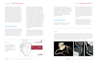 Chapter 13 | EUROPEAN MR/CT REGISTRY 131130 Chapter 13 | EUROPEAN MR/CT REGISTRY
THE HEART REVEALED RADIOLOGY IN THE DIAGNOSIS AND MANAGEMENT OF CARDIAC CONDITIONSTHE HEART REVEALED RADIOLOGY IN THE DIAGNOSIS AND MANAGEMENT OF CARDIAC CONDITIONS
the MR/CT Registry in which a representa-
tive sample of cardiac magnetic resonance
imaging (CMR) studies as well as cardiac
computed tomography (CCT) examinations
from all over Europe could be documented
(https://www.mrct-registry.org). The sub-
mission of data is now a pre-requisite for the
accreditation and certification process in
Germany. It also serves as a tool for quality
control in cardiovascular radiology (Figure 1)
and may help to establish a database for big
data analysis, deep learning and the use of
artificial intelligence to improve diagnosis.
A SUCCESS STORY!
Almost six years after the start of the ESCR
Cardiac MR/CT Registry, more than 220,000
cardiac MRI and cardiac CT studies from all
over Europe have been submitted. A slight
imbalance in favour of cardiac magnetic
resonance imaging (CMR) has developed
over the recent years with approximately
118,000 CMRs and 93,000 submitted CCTs.
The majority of participating institutes and
contributing users are from Germany. How-
ever, the 300 contributing institutes come
from 33 different European countries. The
majority of centres are not academic centres
anymore, but larger community hospitals, and
also radiologists in private practice; meaning
that a widespread use and availability of these
new and fascinating non-invasive techniques
is accomplished in clinical routine already in
most European countries. According to the
MR/CT Registry only 2% of CMRs and as few
as 0.3% of CCTs are performed in clinical
trials, all other examinations were performed
due to a real clinical indication and a real
clinical need.
To maintain a high image quality besides
well-trained radiologists (i.e. ESCR Diploma
holders – members of the European Board
of Cardiovascular Radiology – EBCR) ade-
quate equipment is needed. A 1.5T scanner
for CMR and for CCT at least a 64-row CT is
recommended. Fortunately, this prerequisite
is already fulfilled according to the ESCR MR/
CT Registry data. Almost 80% of contributing
users used a 1.5T system and approximately
20% even a 3.0T system. On the CT side
approximately 99% of the users are using a
64-row CT or higher.
MAIN INDICATIONS
As the direct competitor of ICA, it is unsur-
prising that CCT is mainly performed in
known or suspected coronary artery disease
(CAD) and accounts for more than 2/3 of all
cardiac CT examinations, followed by valve
and aortic diseases, mainly to plan interven-
tional or surgical procedures. Actually, CCT
has the potential to evaluate CAD even bet-
ter than ICA, because it cannot only visualise
the vessel lumen, but also the vessel wall
(Figure 2).
The main indications for CMR are the
evaluation or differential diagnosis of car-
diomyopathies and myocarditis, closely
followed by the evaluation of known or
suspected CAD. Both account for more
Figure 1
Cover page of the recent ESCR
Cardiac MR/CT Registry booklet,
which can be downloaded for free
via the following URL:
https://www.mrct-registry.org/
images/ESCR_2018_CardiacMRCT-
booklet.pdf
Figure 2
Non-invasive imaging by coronary computed tomography angiography (CCTA) in a male patient with a high-degree stenosis
(narrowing of the vessel) of the middle section of the right coronary artery (RCA) using a 3D-visualisation method, that shows
only the inner lumen of the three coronary vessels (‘coronary vessel tree’) and the aortic root (A) and the corresponding ‘curved
multiplanar reformats’ (CPRs) in (B, C) from different views, which also allows assessing the vessel wall two-dimensionally. Here
you can see that the high degree stenosis (blue arrow) is caused by a non-calcified, so-called ‘low-attenuation’ plaque, which
has a worse prognosis than calcified plaques. A direct visualisation of the vessel wall is not possible with ICA.
A B C
 