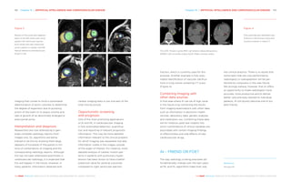 Chapter 15 | ARTIFICIAL INTELLIGENCE AND CARDIOVASCULAR DISEASE  153152 Chapter 15 | ARTIFICIAL INTELLIGENCE AND CARDIOVASCULAR DISEASE
THE HEART REVEALED RADIOLOGY IN THE DIAGNOSIS AND MANAGEMENT OF CARDIAC CONDITIONSTHE HEART REVEALED RADIOLOGY IN THE DIAGNOSIS AND MANAGEMENT OF CARDIAC CONDITIONS
imaging that comes to mind is automated
determination of aortic volumes to determine
the degree of expansion due to pumping
action of the heart or to assess volume and
rate of growth of an abnormally enlarged or
aneurysmal aorta.
Interpretation and diagnosis
Researchers are now attempting to gen-
erate complete radiology reports from
images only. DL algorithms are being
trained to do this by showing them large
datasets of hundreds of thousands to mil-
lions of combinations of imaging and the
corresponding radiology reports. Although
this has not been attempted specifically in
cardiovascular radiology, it is expected that
this will happen in the future. However, in
many patients, information obtained with
cardiac imaging tests is just one part of the
total clinical picture.
Opportunistic screening
and prognosis
One of the most promising applications
of AI and ML in cardiovascular imaging
is fully automated detection, quantifica-
tion and reporting of relevant prognostic
information. This may be more detailed
information relevant to the clinical problem
for which imaging was requested, but also
information visible in the images outside
of the organ of interest. For instance, more
detailed analysis of cardiac motion pat-
terns in patients with pulmonary hyper-
tension has been shown to have a better
predictive value for adverse outcomes
compared to right ventricular ejection
fraction, which is currently used for this
purpose. Another example is fully auto-
mated identification of vascular calcifica-
tions in lung cancer screening CT scans
(Figure 4).
Combining imaging with
other data sources
A final area where AI can be of high value
in the future is by combining the results
from imaging examinations with other data
such as information in electronic health
records, laboratory data, genetic analyses
and medication use. Combining these data
will for instance yield new insights into
which combinations of clinical variables are
associated with certain imaging findings
or effectiveness and side effects of new
cardiovascular drugs.
AI – FRIEND OR FOE?
The way radiology is being practised will
fundamentally change over the next years
as ML and DL algorithms make their way
into clinical practice. There is no doubt that
some tasks that are now performed by
radiologists or radiographers will be per-
formed by computers in the near future.
We strongly believe, however, that AI offers
an opportunity to make radiologists more
accurate, more productive and to deliver
better care precisely tailored to individual
patients. AI will quickly become one of our
best friends.
References
See page 236
Figure 3
Results of fully automatic segmen-
tation of the left ventricular cavity
(green), left ventricular myocar-
dium (blue) and right ventricular
cavity (yellow) in cardiac cine MR.
Manual reference annotations are
shown in red.
Figure 4
Fully automatically identified calci-
fications in the thoracic aorta and
coronary arteries in chest CT.
YELLOW: Thoracic aorta, RED: Left anterior descending artery,
GREEN: Left circumflex artery, BLUE: Right coronary artery
 