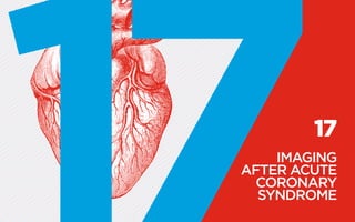 17
IMAGING
­AFTER ACUTE
CORONARY
SYNDROME
 