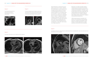 Chapter 19 | CARDIAC MRI: THE RADIO­GRAPHERS’ ­PERSPECTIVE 193192 Chapter 19 | CARDIAC MRI: THE RADIO­GRAPHERS’ ­PERSPECTIVE
THE HEART REVEALED RADIOLOGY IN THE DIAGNOSIS AND MANAGEMENT OF CARDIAC CONDITIONSTHE HEART REVEALED RADIOLOGY IN THE DIAGNOSIS AND MANAGEMENT OF CARDIAC CONDITIONS
blood haematocrit, calculating the extra-
cellular volume (ECV) fraction. Oedema,
from inflammation or acute infarction, and
increased interstitial space from fibrosis
or amyloid deposition are the two most
important reasons for an increased native
(non-contrast) T1. Lipid or iron overload
are the two most important for decreased
native T1. Native T1-mapping is possible
in patients where poor renal function is a
contraindication to contrast administration
and so LGE cannot be performed. ECV
is a marker of tissue remodelling and an
increased ECV is most often due to exces-
sive collagen deposition1
.
Blood flow in the heart and great vessels is
multidirectional and pulsatile and 4D phase
contrast CMR has enabled visualisation of mul-
ti-directional flow features. In the aorta, areas
of high-velocity flow close to vessel walls may
indicate altered fluid mechanical effects on
the vessel wall, and in complex congenital
heart disease studies using 4D flow, imaging is
showing potential applications2
.
CMR has also become an important com-
ponent of risk stratification and procedural
planning in congenital and paediatric heart
diseases. Innovative approaches to image
acquisition and reconstruction are leading
Figure 2
T1 axial image showing fatty fibrosis
of right ventricular free wall in
arrhythmogenic right ventricular
cardiomyopathy.
Figure 3
T2 short axis images showing (A) oedema in right coronary
artery territory (inferior wall) due to late presentation myo-
cardial infarct, with microvascular obstruction, (B) oedema
in non-coronary artery territories in acute myocarditis.
A B
Figure 4
Axial image of cardiac mass with (A) T1 weighting and (B) T2 weighting.
A B
Figure 5
Late gadolinium enhancement images showing (A) subendocardial LGE due to myocardial infarct in right coronary artery territory and
(B) epicardial LGE in acute myocarditis.
A B
 