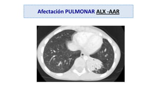 Afectación PULMONAR ALX -AAR
 