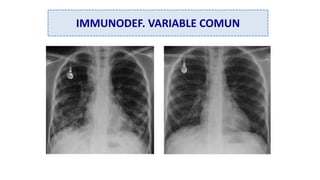 IMMUNODEF. VARIABLE COMUN
 