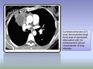 Contrast-enhanced (CT)
scan demonstrates large
focal area of decreased
attenuation with rim
enhancement (arrow)
characteristic of lung
abscess.
 