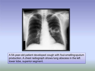 A 54-year-old patient developed cough with foul-smellingsputum
production. A chest radiograph shows lung abscess in the left
lower lobe, superior segment.
 