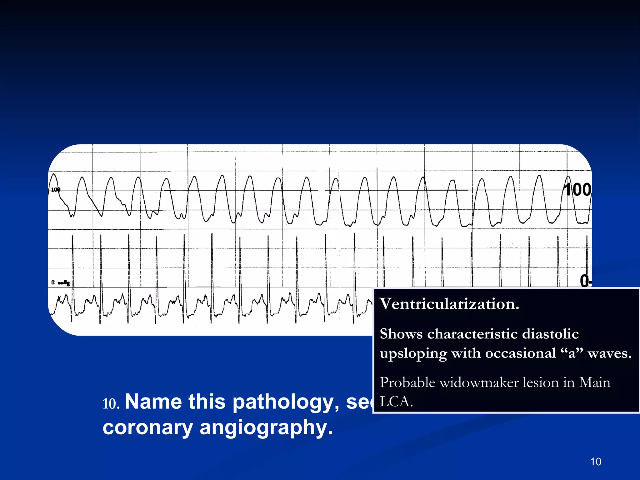 .   Name this pathology, seen during coronary angiography. Ventricularization.   Shows characteristic diastolic upsloping with occasional “a” waves. Probable widowmaker lesion in Main LCA. 
