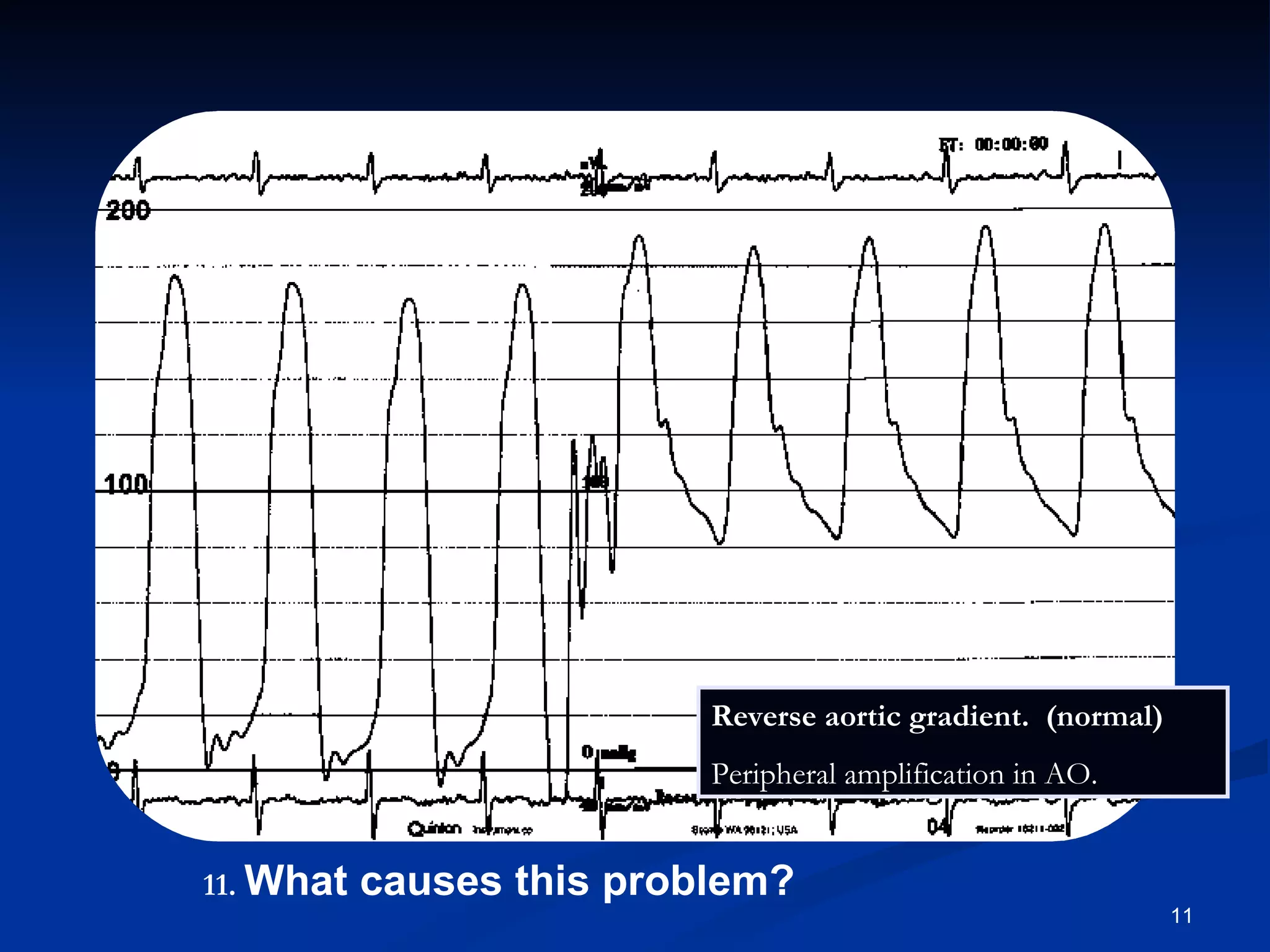 .   What causes this problem? Reverse aortic gradient.  (normal) Peripheral amplification in AO. 