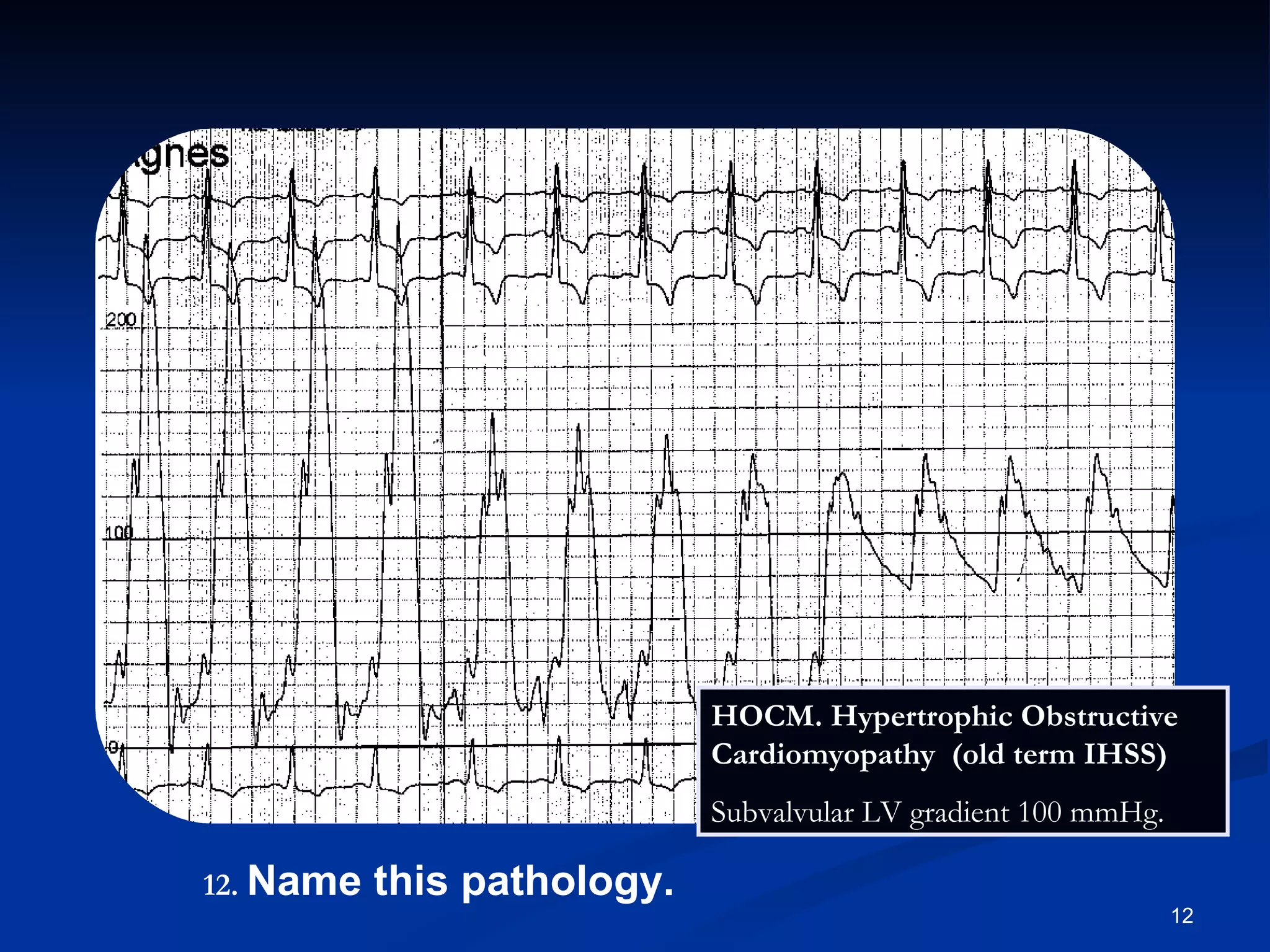 .   Name this pathology. HOCM. Hypertrophic Obstructive Cardiomyopathy  (old term IHSS)  Subvalvular LV gradient 100 mmHg. 