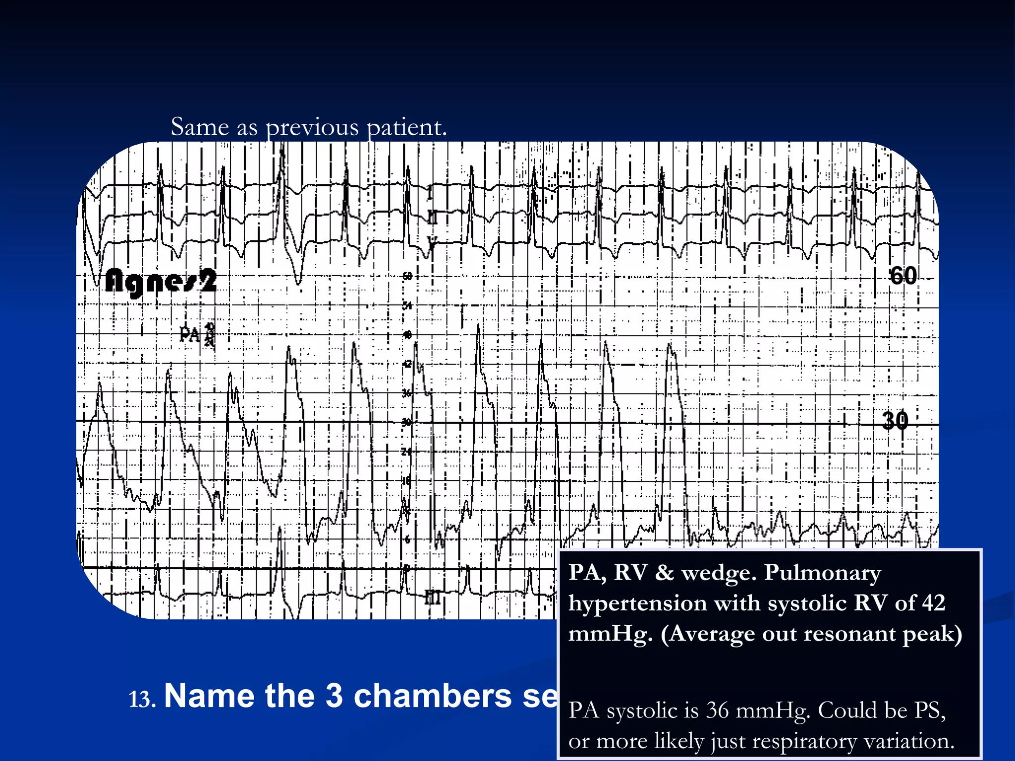 .   Name the 3 chambers seen in this pullback. PA, RV & wedge. Pulmonary hypertension with systolic RV of 42 mmHg. (Average out resonant peak)  PA systolic is 36 mmHg. Could be PS, or more likely just respiratory variation. Same as previous patient. 30 60 