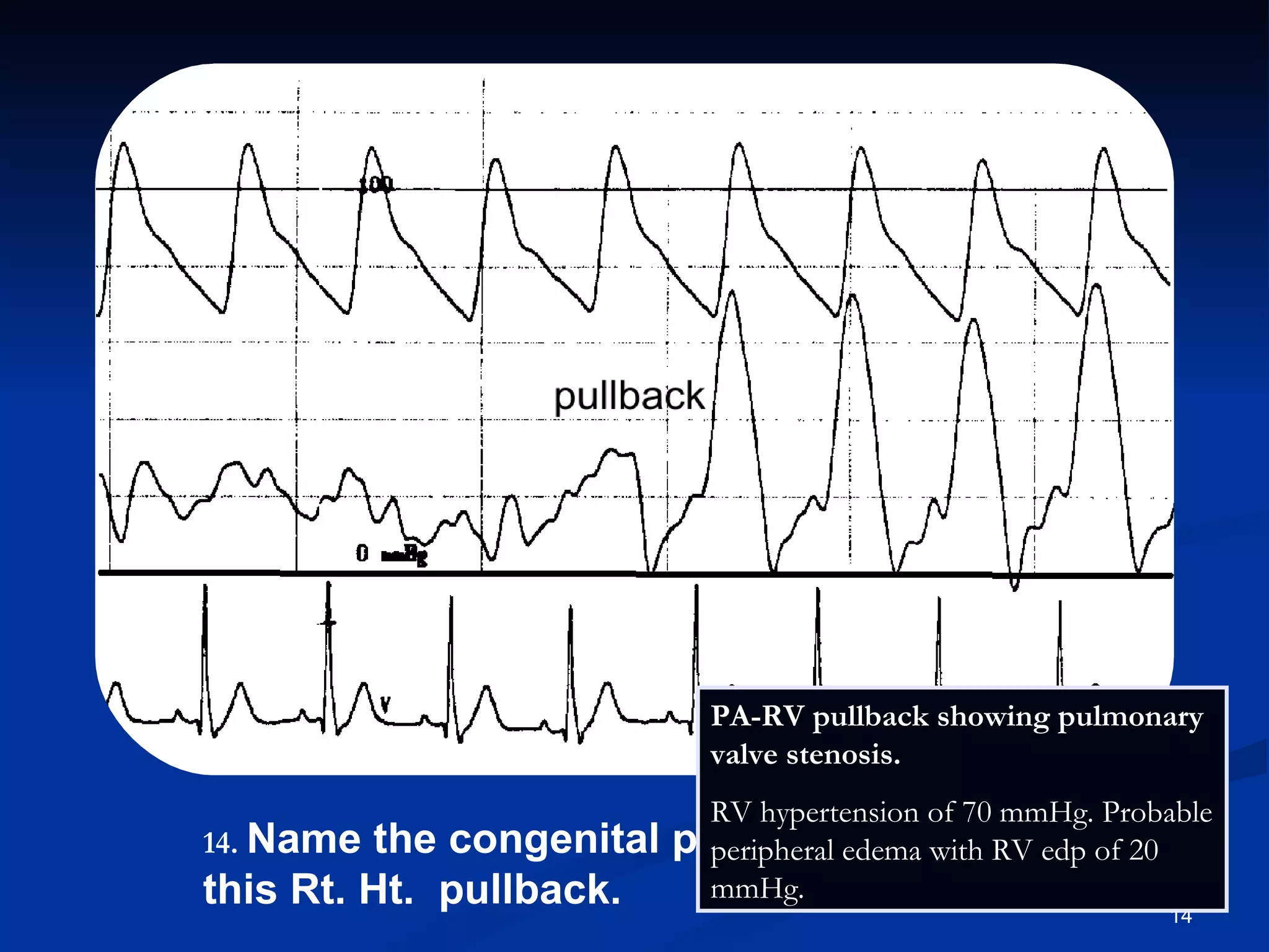 .   Name the congenital pathology seen in this Rt. Ht.  pullback. PA-RV pullback showing pulmonary valve stenosis.  RV hypertension of 70 mmHg. Probable peripheral edema with RV edp of 20 mmHg. 