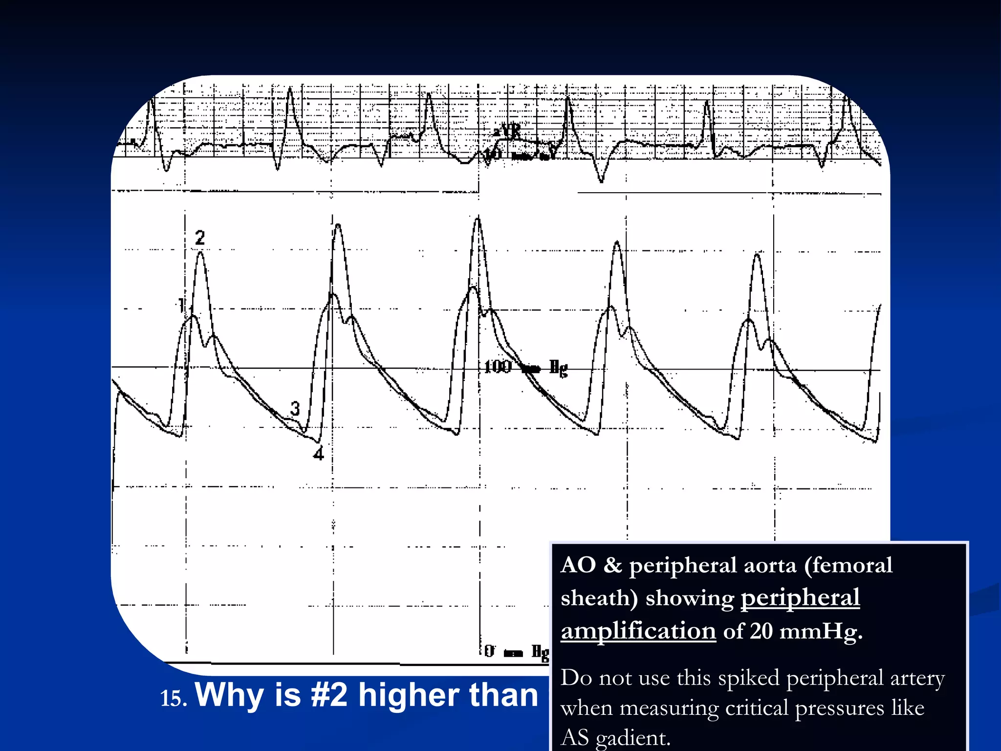.   Why is #2 higher than #1? AO & peripheral aorta (femoral sheath) showing  peripheral amplification  of 20 mmHg.  Do not use this spiked peripheral artery when measuring critical pressures like AS gadient. 