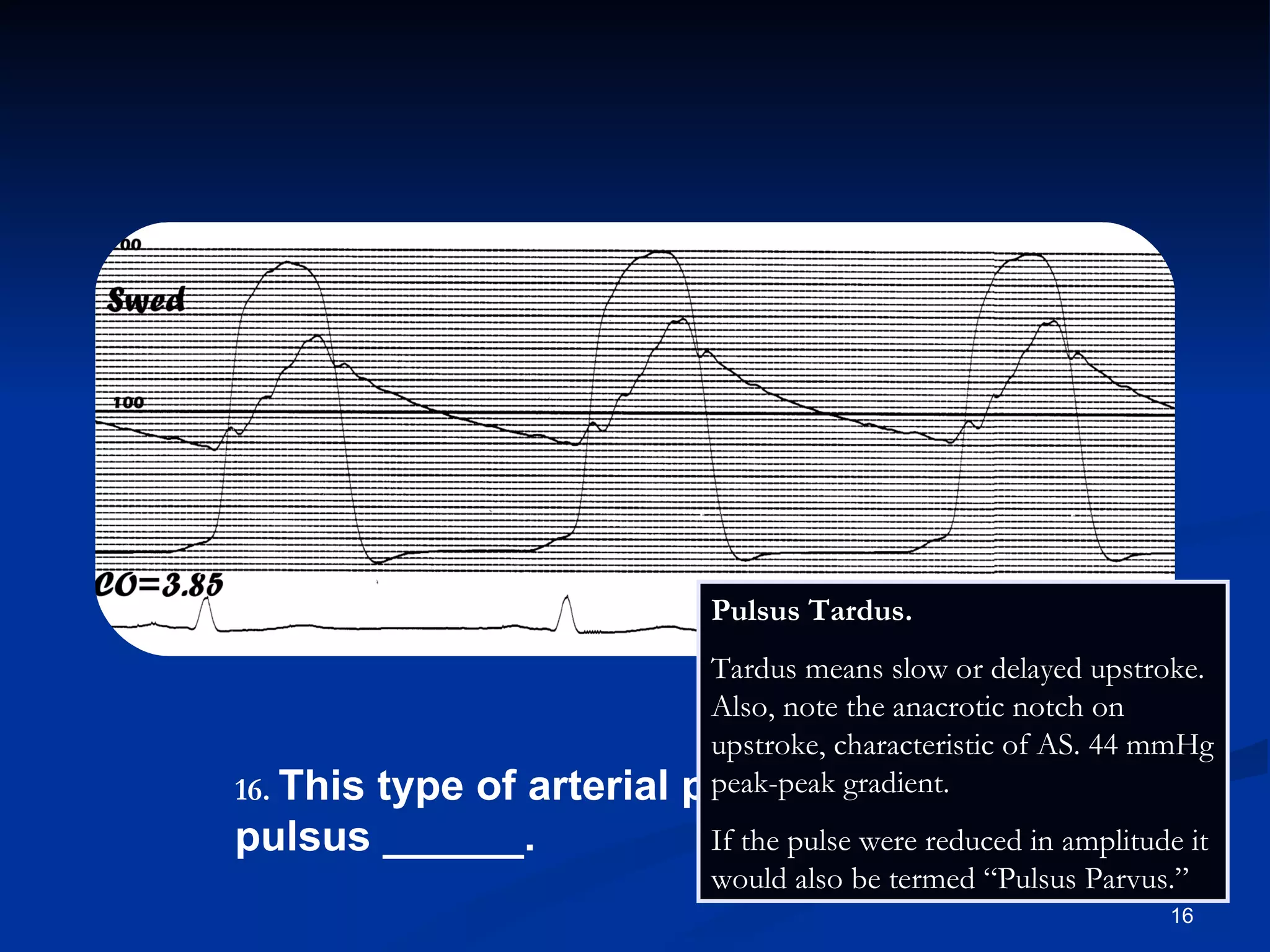 .   This type of arterial pulse is termed pulsus ______. Pulsus Tardus. Tardus means slow or delayed upstroke. Also, note the anacrotic notch on upstroke, characteristic of AS. 44 mmHg peak-peak gradient. If the pulse were reduced in amplitude it would also be termed “Pulsus Parvus.” 