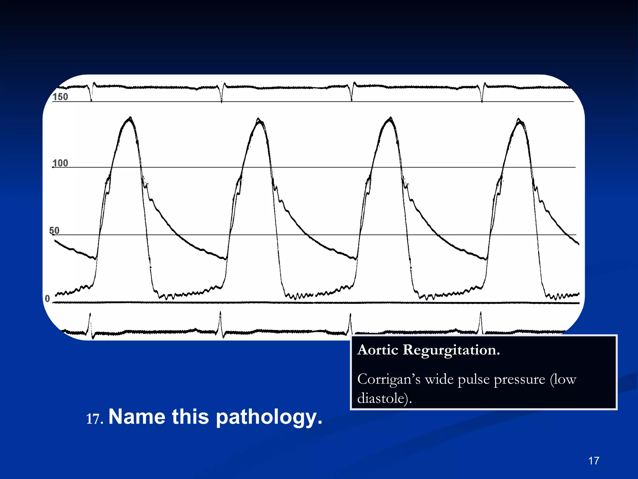 Aortic Regurgitation.  Corrigan’s wide pulse pressure (low diastole).  .   Name this pathology. 