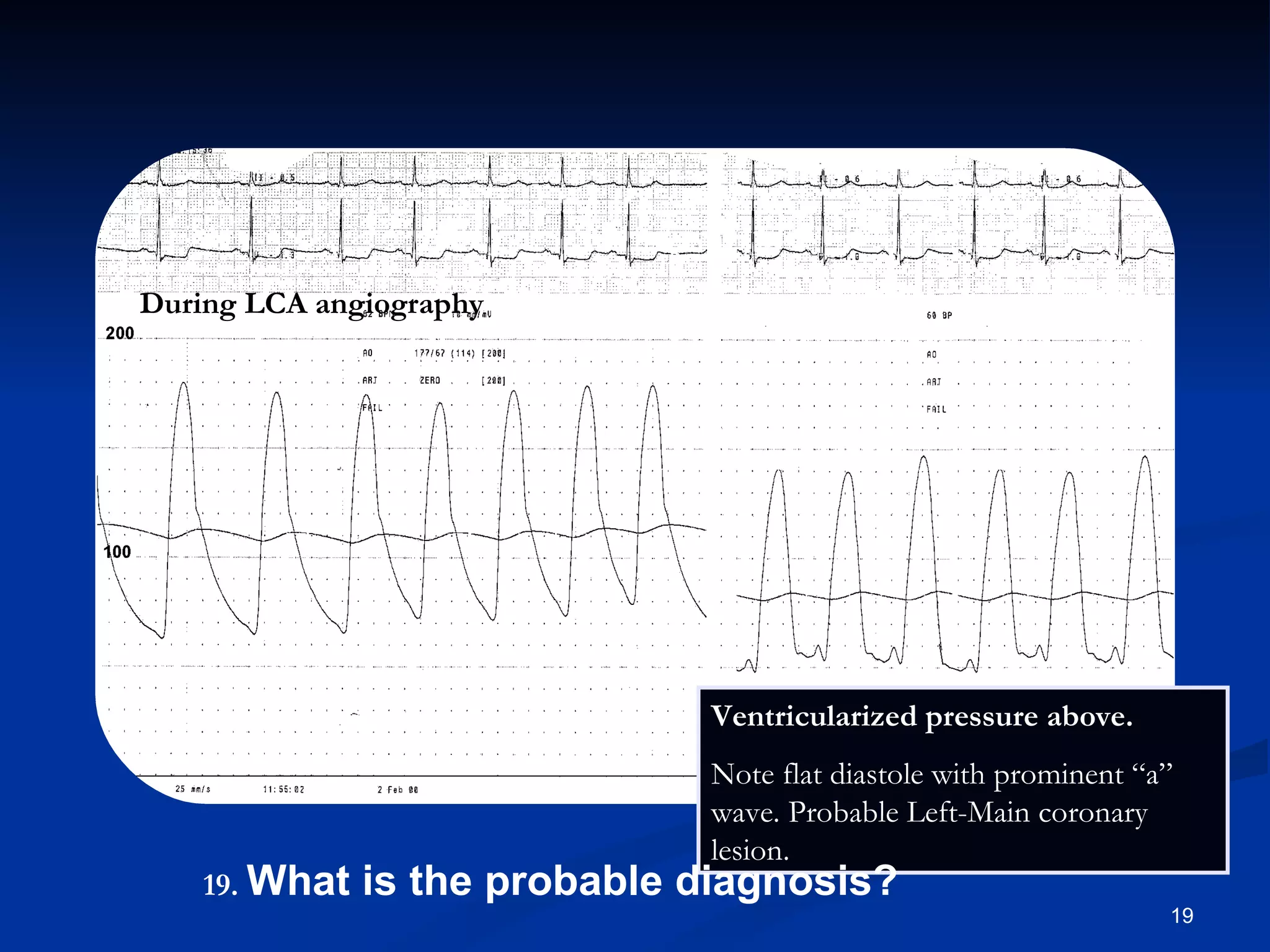 Ventricularized pressure above. Note flat diastole with prominent “a” wave. Probable Left-Main coronary lesion. During LCA angiography .   What is the probable diagnosis? 