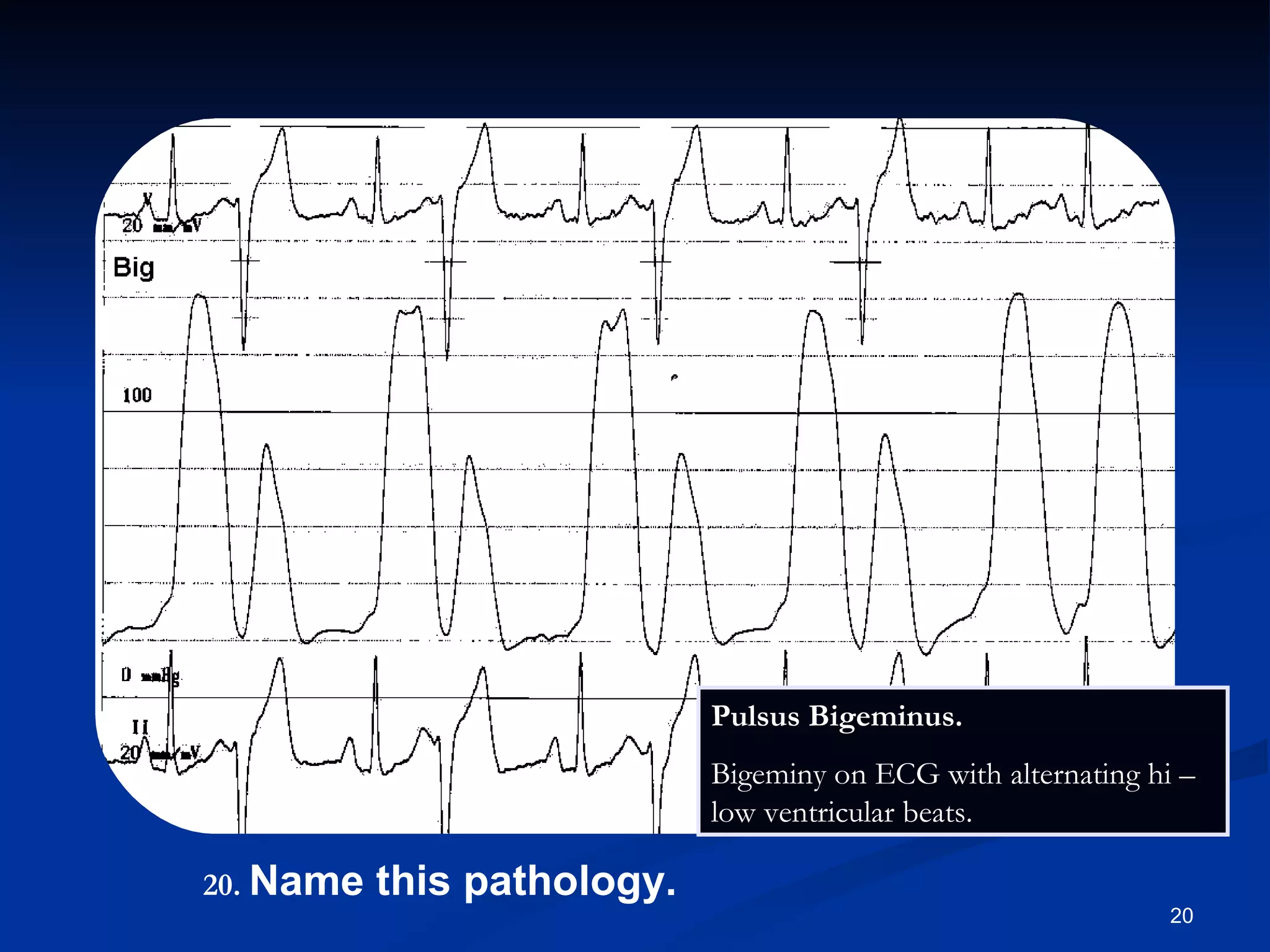 .   Name this pathology. Pulsus Bigeminus.  Bigeminy on ECG with alternating hi – low ventricular beats. 