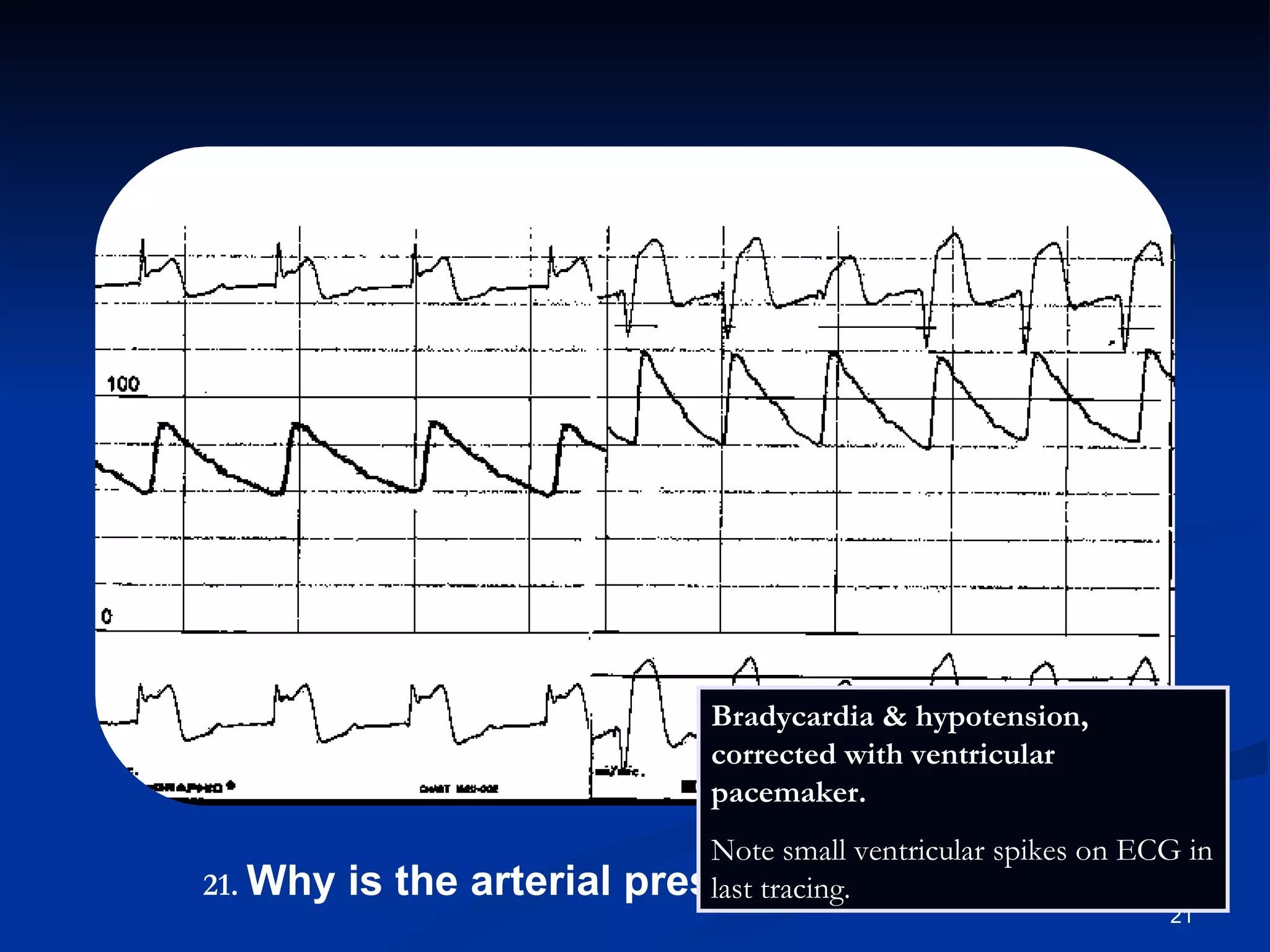 .   Why is the arterial pressure imroved? Bradycardia & hypotension, corrected with ventricular pacemaker.  Note small ventricular spikes on ECG in last tracing. 