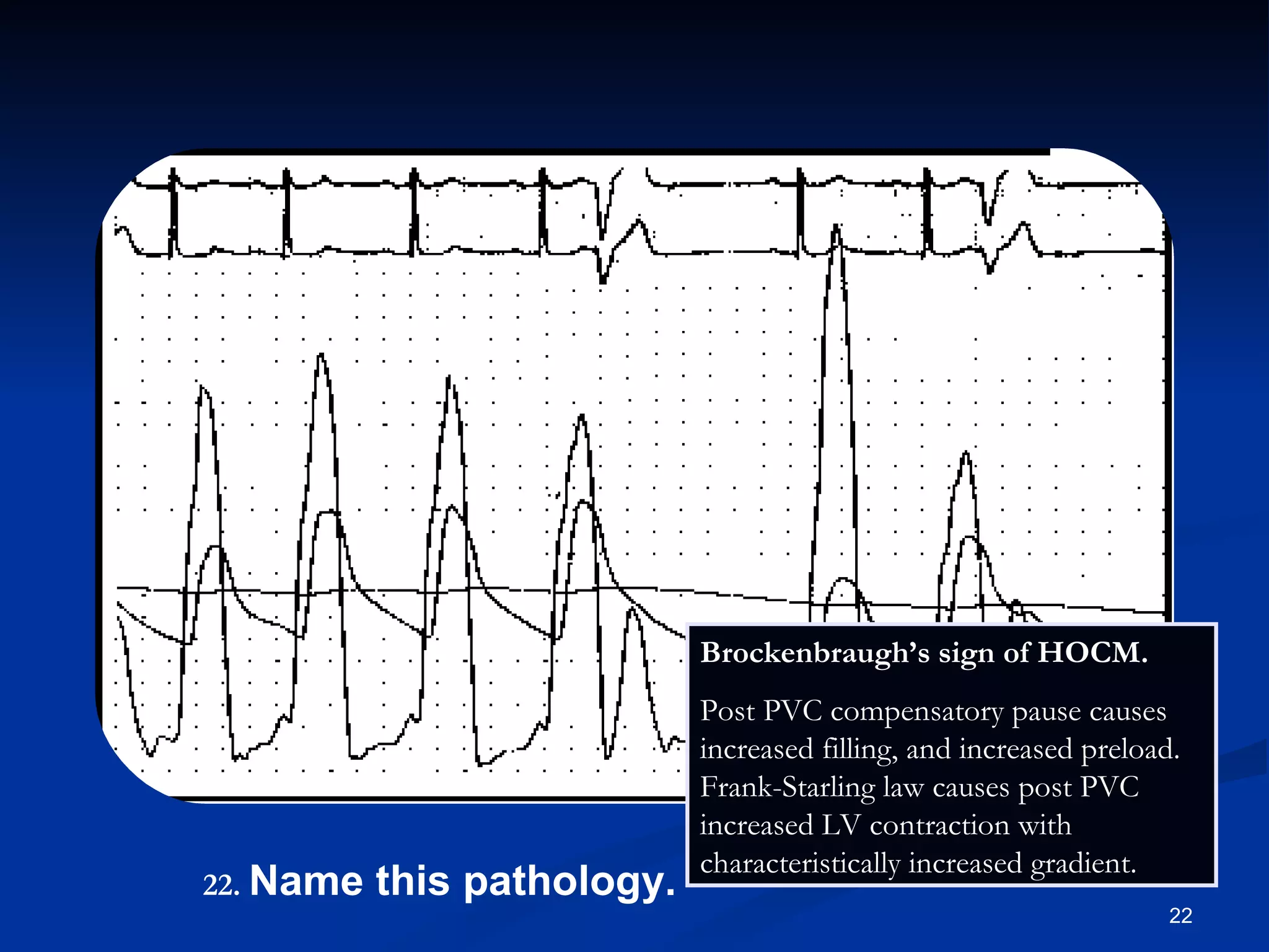 .   Name this pathology. Brockenbraugh’s sign of HOCM.  Post PVC compensatory pause causes increased filling, and increased preload. Frank-Starling law causes post PVC  increased LV contraction with characteristically increased gradient. 