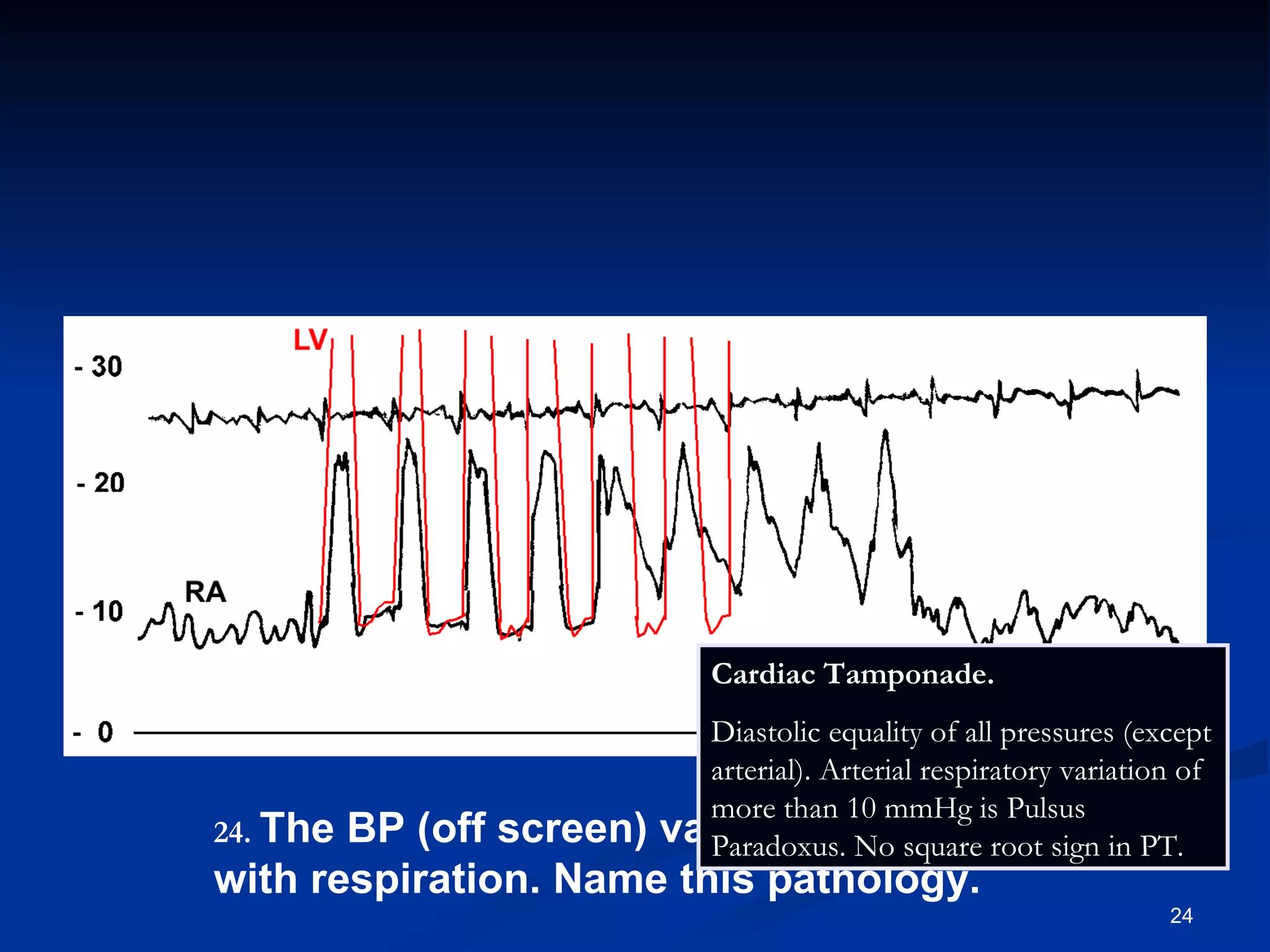 .   The BP (off screen) varies markedly with respiration. Name this pathology. Cardiac Tamponade.  Diastolic equality of all pressures (except arterial). Arterial respiratory variation of more than 10 mmHg is Pulsus Paradoxus. No square root sign in PT. 