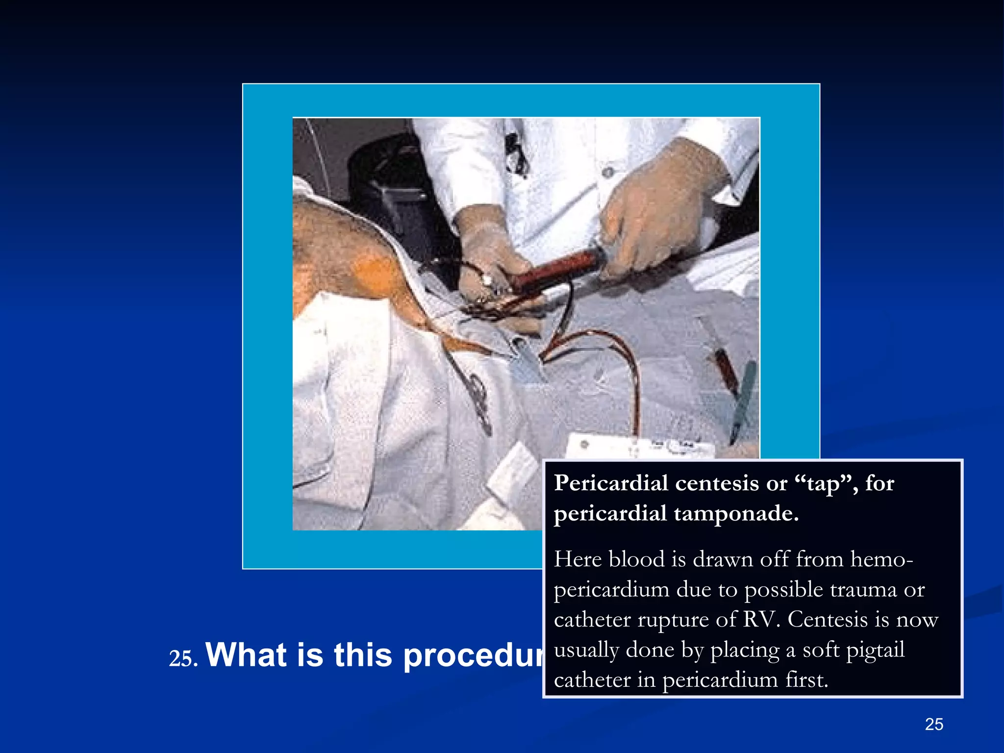 .   What is this procedure? Pericardial centesis or “tap”, for pericardial tamponade.  Here blood is drawn off from hemo-pericardium due to possible trauma or catheter rupture of RV. Centesis is now usually done by placing a soft pigtail catheter in pericardium first. 