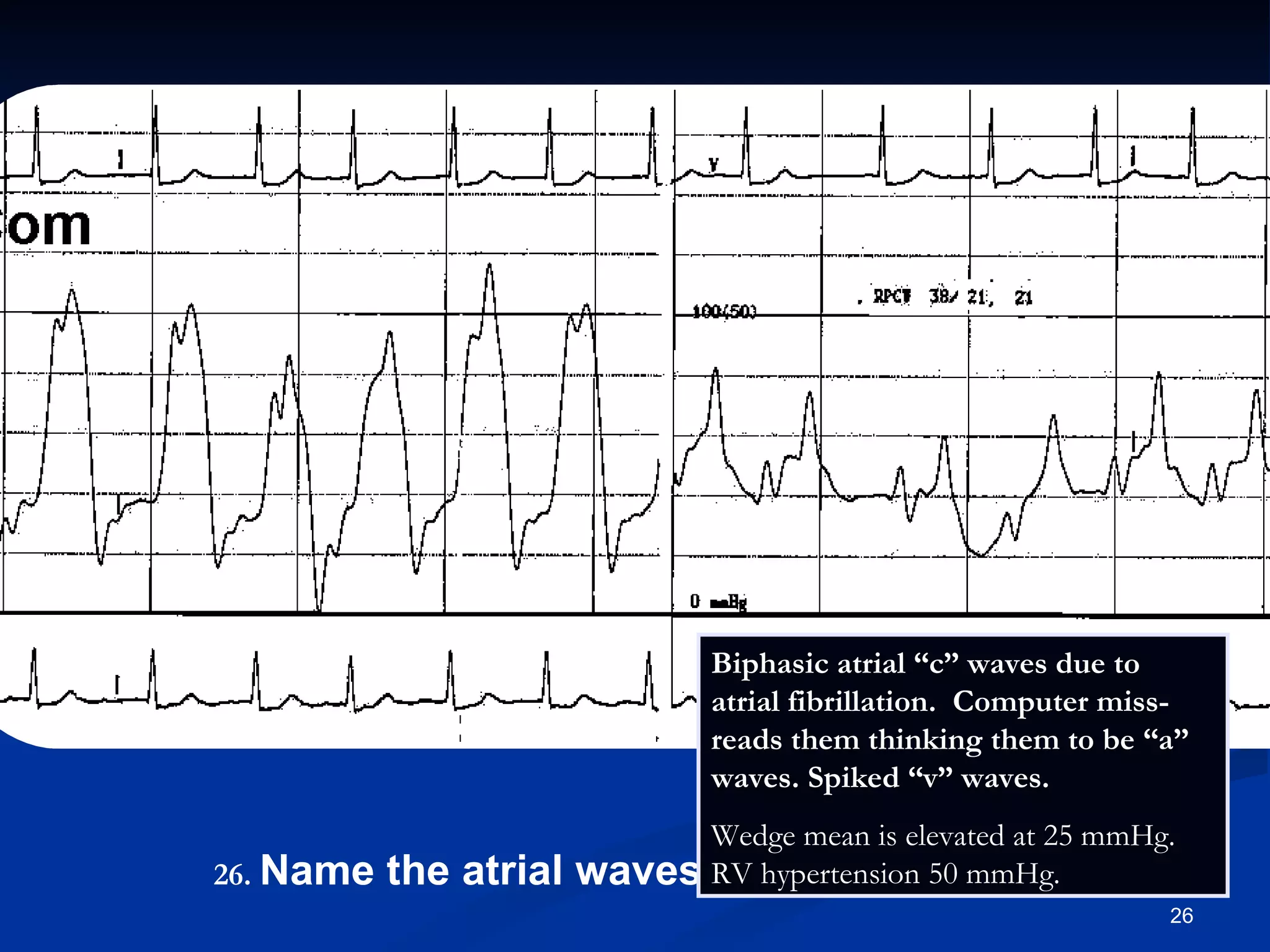.   Name the atrial waves seen. Biphasic atrial “c” waves due to atrial fibrillation.  Computer miss-reads them thinking them to be “a” waves. Spiked “v” waves.  Wedge mean is elevated at 25 mmHg. RV hypertension 50 mmHg.  