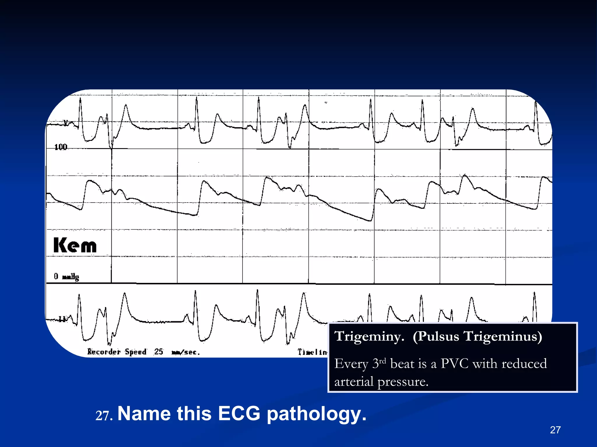 .   Name this ECG pathology. Trigeminy.  (Pulsus Trigeminus) Every 3 rd  beat is a PVC with reduced arterial pressure. 