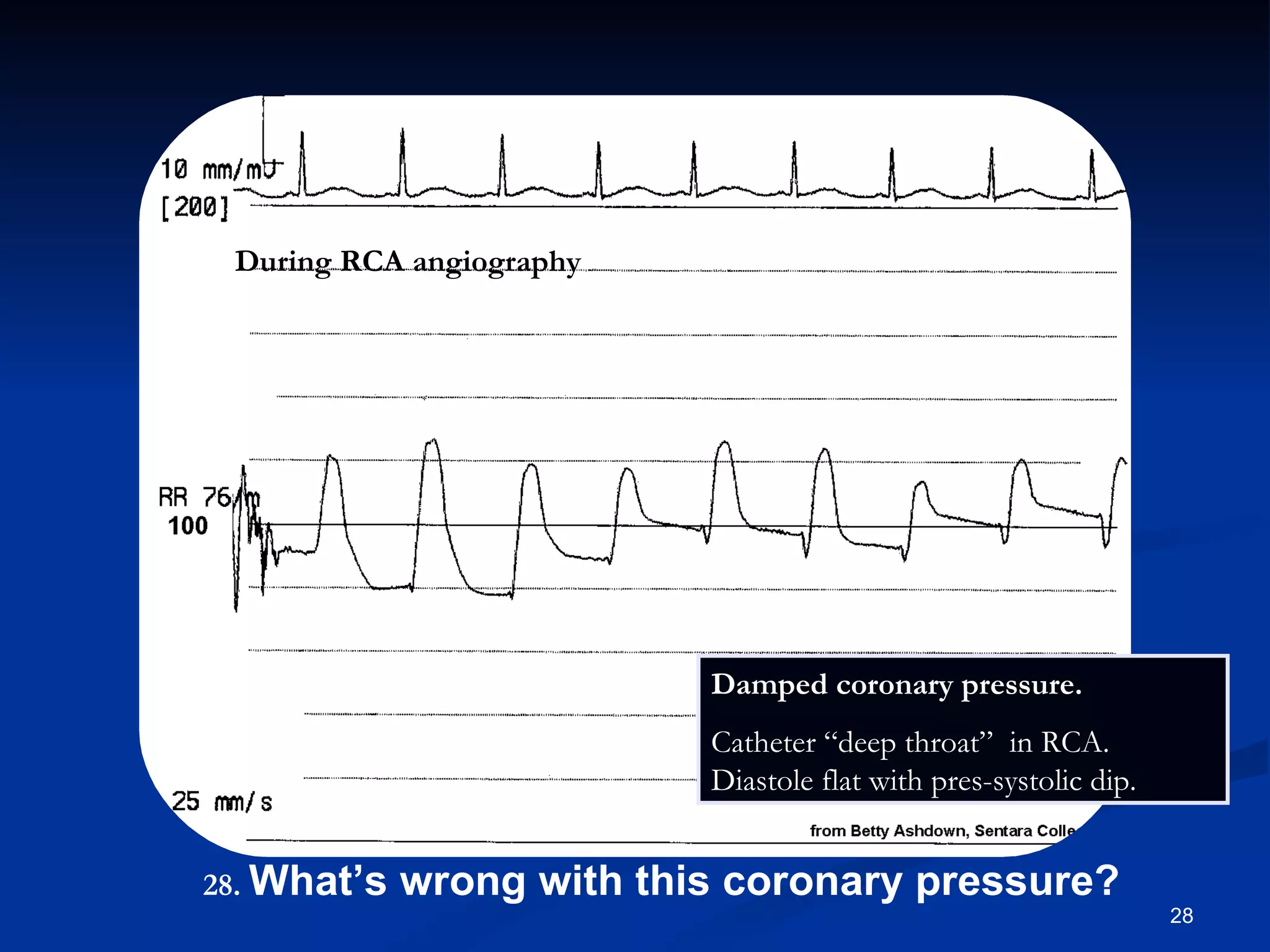 Damped coronary pressure. Catheter “deep throat”  in RCA. Diastole flat with pres-systolic dip. During RCA angiography .   What’s wrong with this coronary pressure? 