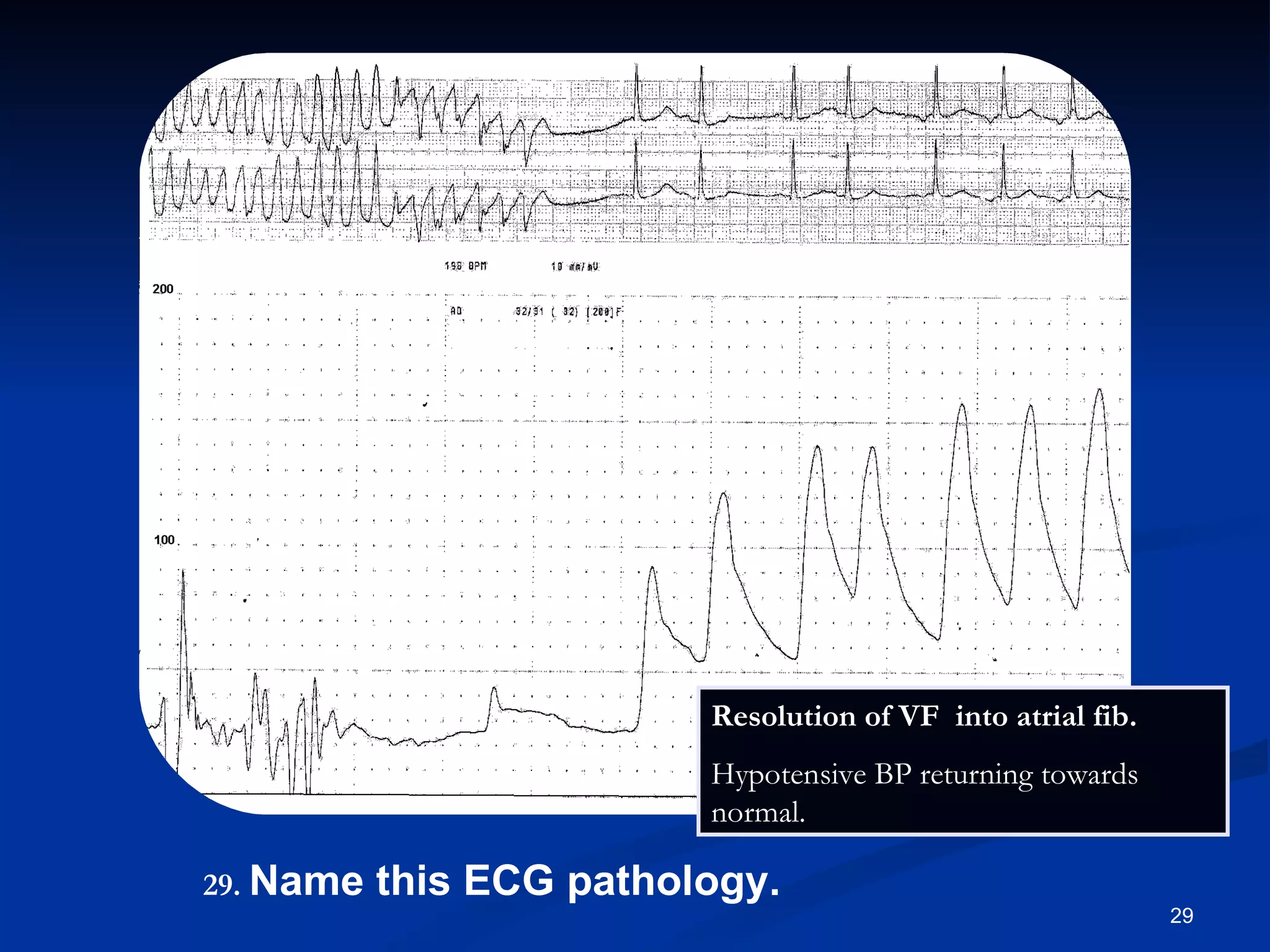 Resolution of VF  into atrial fib. Hypotensive BP returning towards normal. .   Name this ECG pathology. 