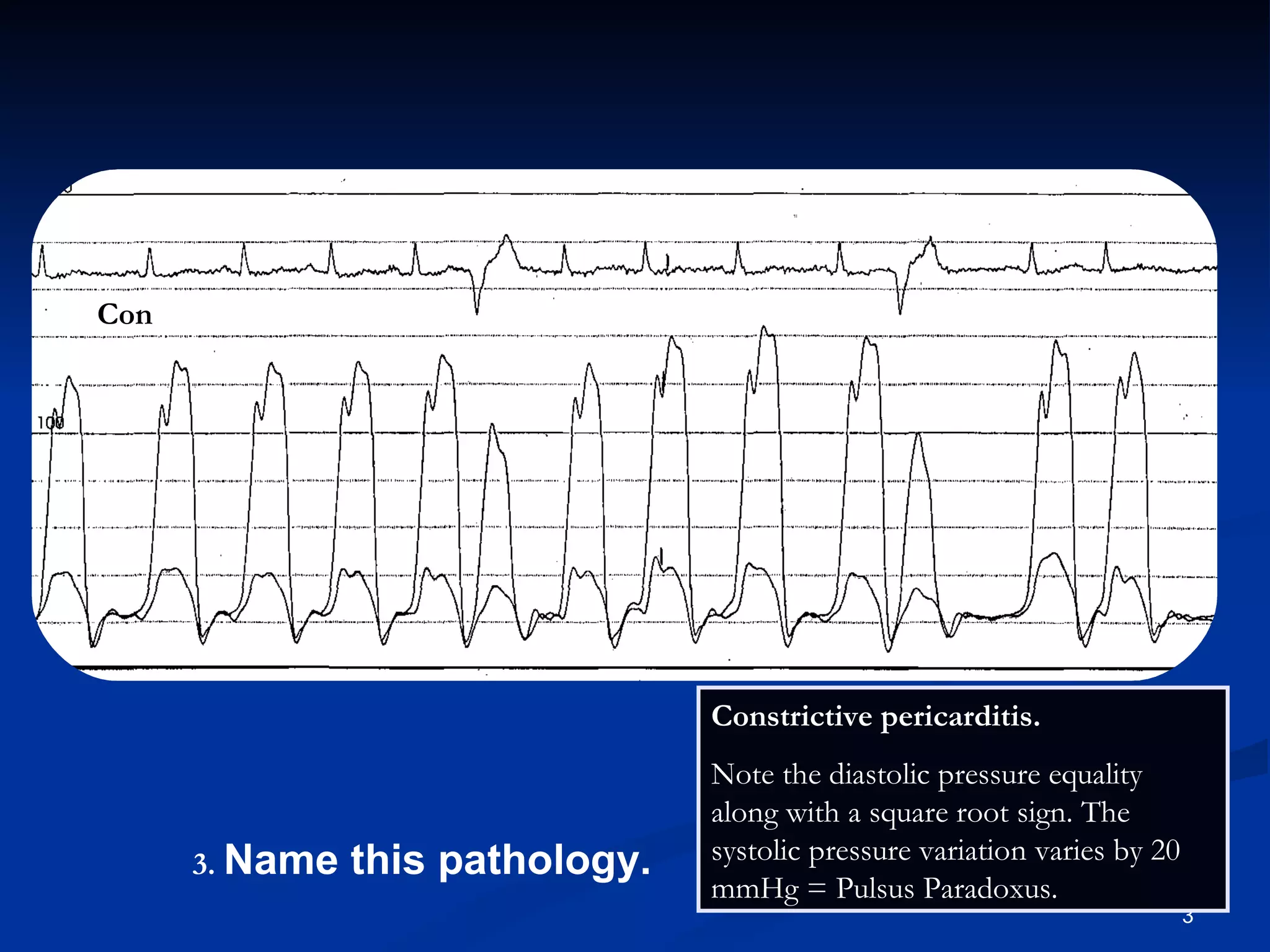 Con .   Name this pathology. Constrictive pericarditis.  Note the diastolic pressure equality along with a square root sign. The systolic pressure variation varies by 20 mmHg = Pulsus Paradoxus. 