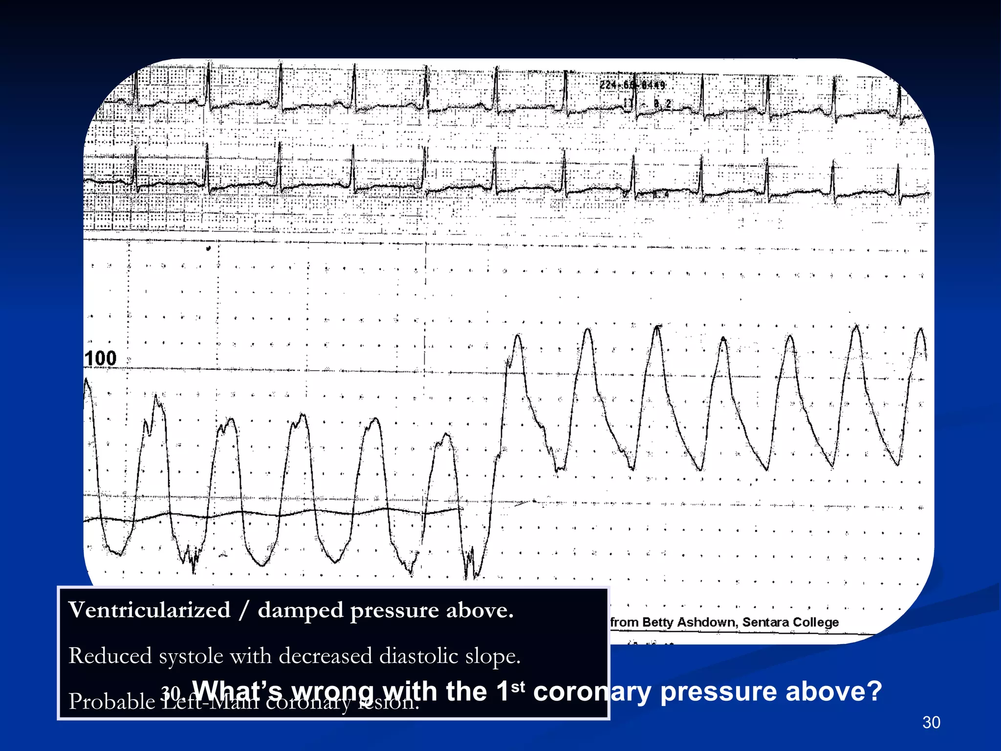 Ventricularized / damped pressure above. Reduced systole with decreased diastolic slope.  Probable Left-Main coronary lesion. .   What’s wrong with the 1 st  coronary pressure above? 