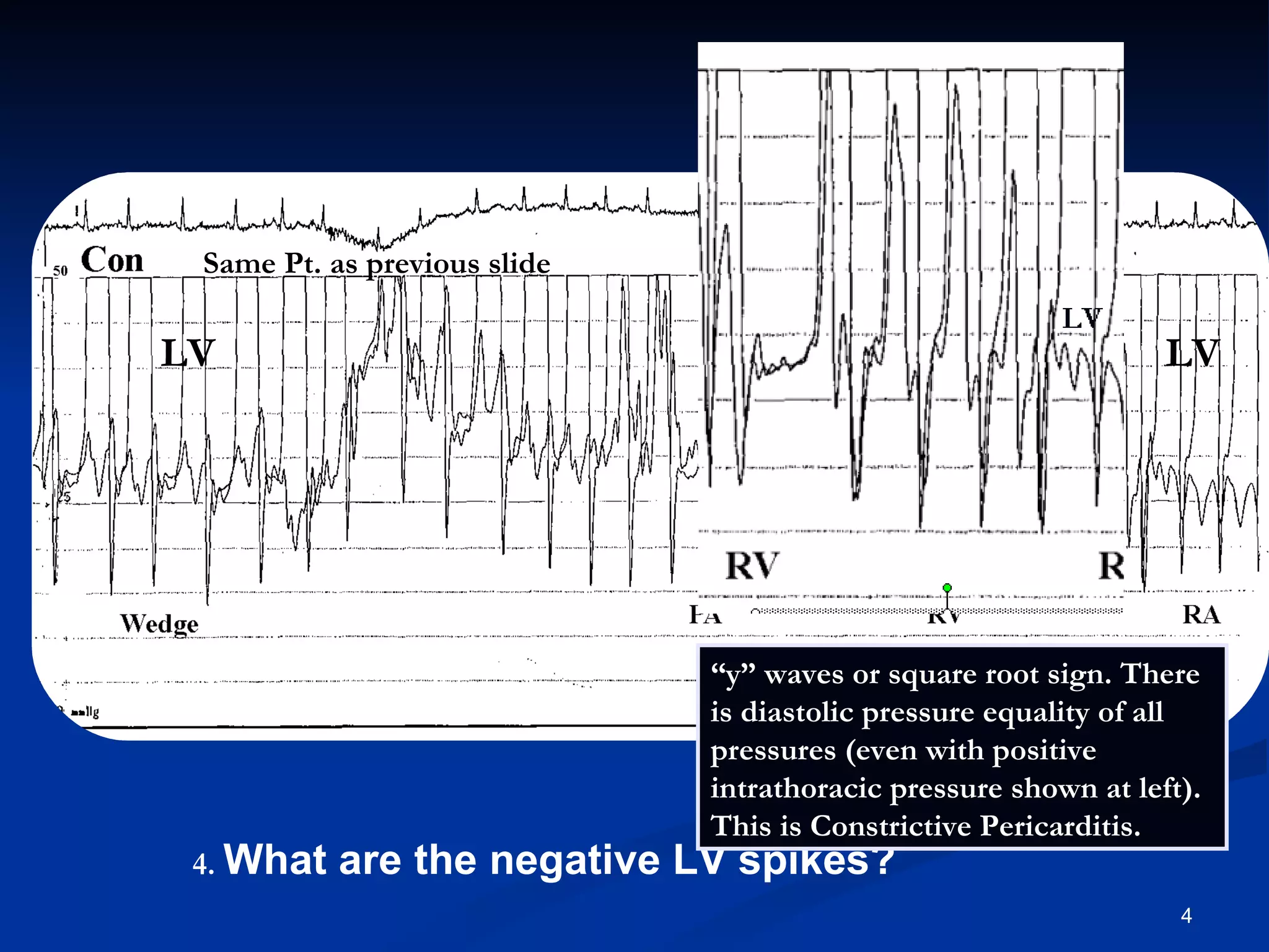 Same Pt. as previous slide .   What are the negative LV spikes? LV LV “ y” waves or square root sign. There is diastolic pressure equality of all pressures (even with positive intrathoracic pressure shown at left). This is Constrictive Pericarditis.  