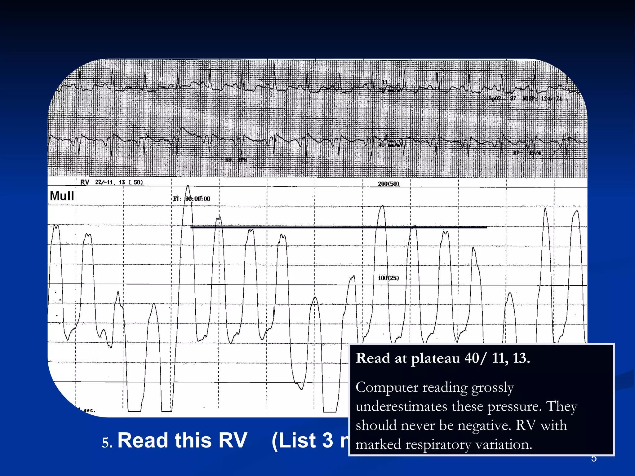.   Read this RV  (List 3 numbers). Read at plateau 40/ 11, 13.  Computer reading grossly underestimates these pressure. They  should never be negative. RV with marked respiratory variation.  
